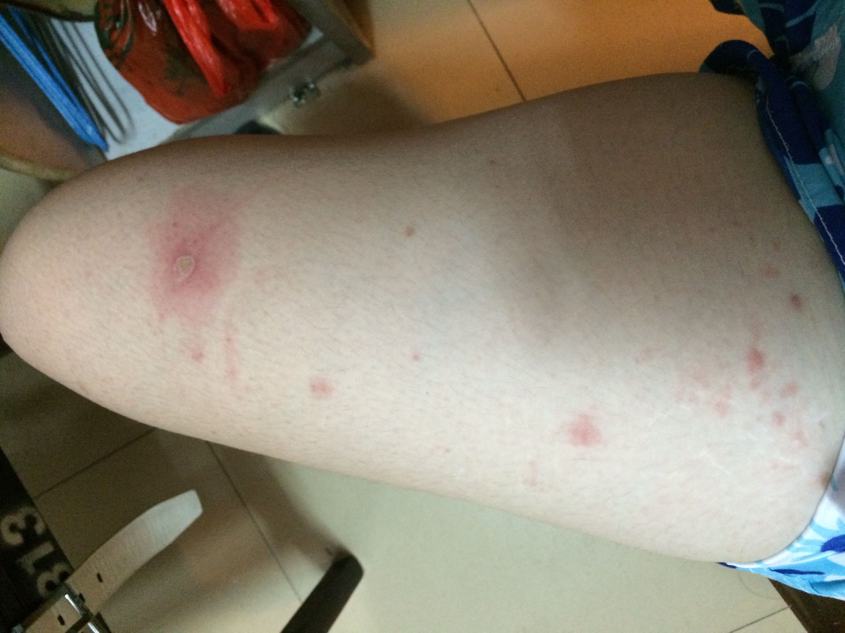 前两天突然身上多了些红疙瘩,我以为是蚊子咬的包,很痒,就抓