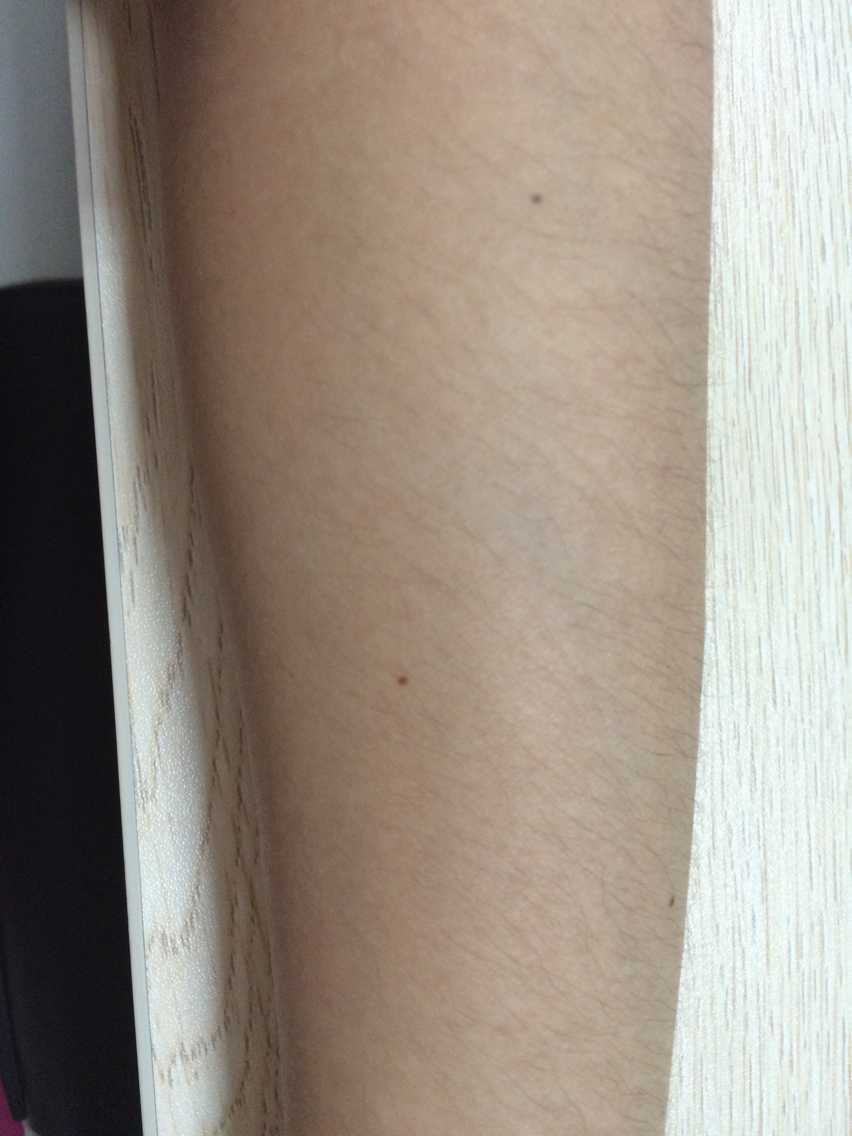 去年还是左手臂长了很多对称的褐色和黑色的斑点,不知道是不是痣