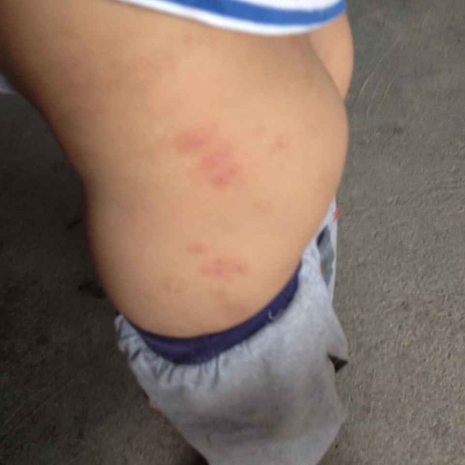 我3岁的侄子经常长疹子,像蚊子咬的一样,不发烧,痒