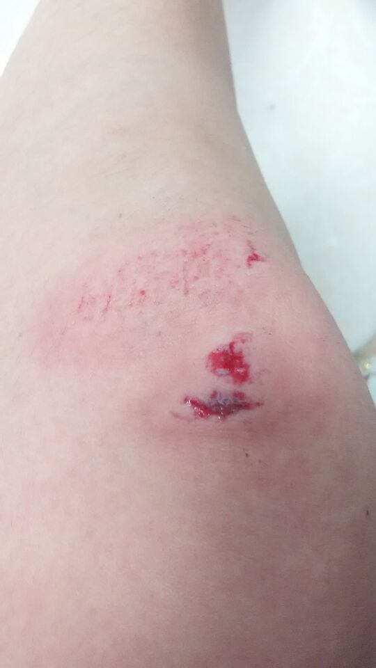 我刚刚摔了一跤手掌破了但不严重重点是膝盖破了很大一块也