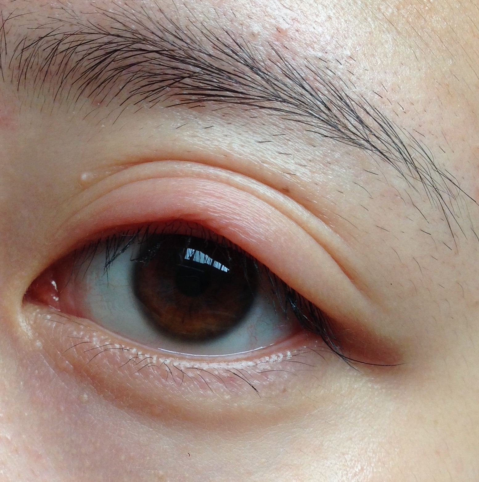 眼睛上眼皮红肿疼痛,昨天只是小伟有些肿,以为是水肿,第二天早