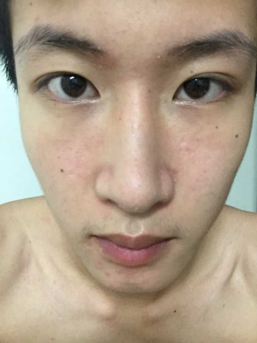 首页 皮肤性病科 皮肤科  性别:男年龄:20岁 病情描述: 脸上一直脱皮.