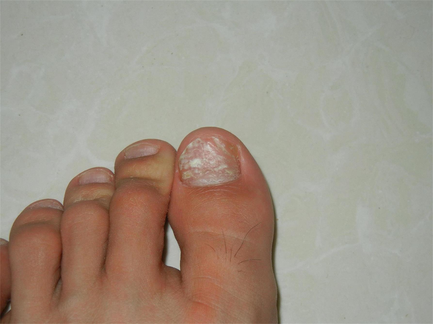 我的左脚大拇指指甲凹凸不平,并且有白斑,已经有半年了,其他脚