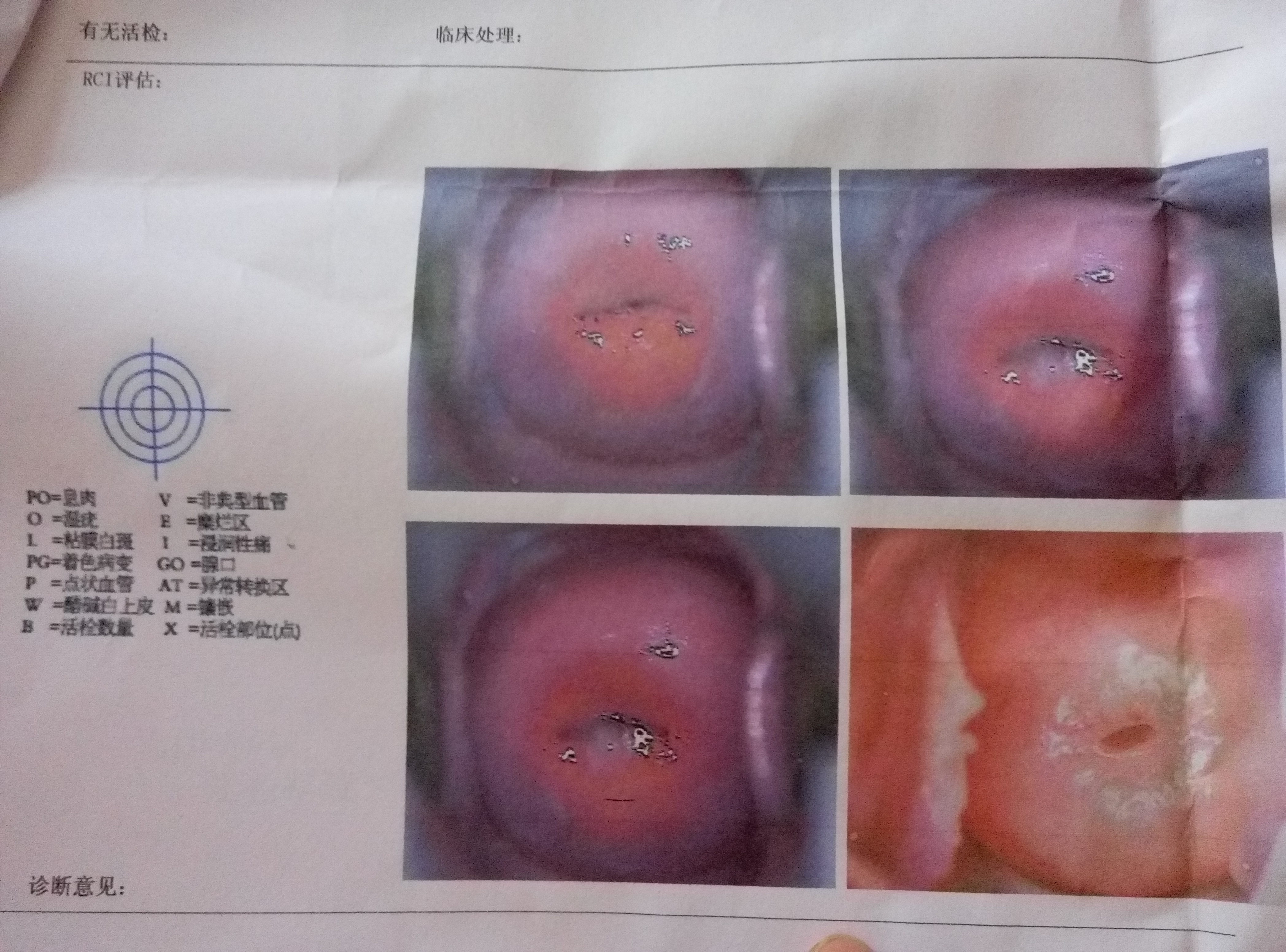 請問報告顯示是幾度糜爛