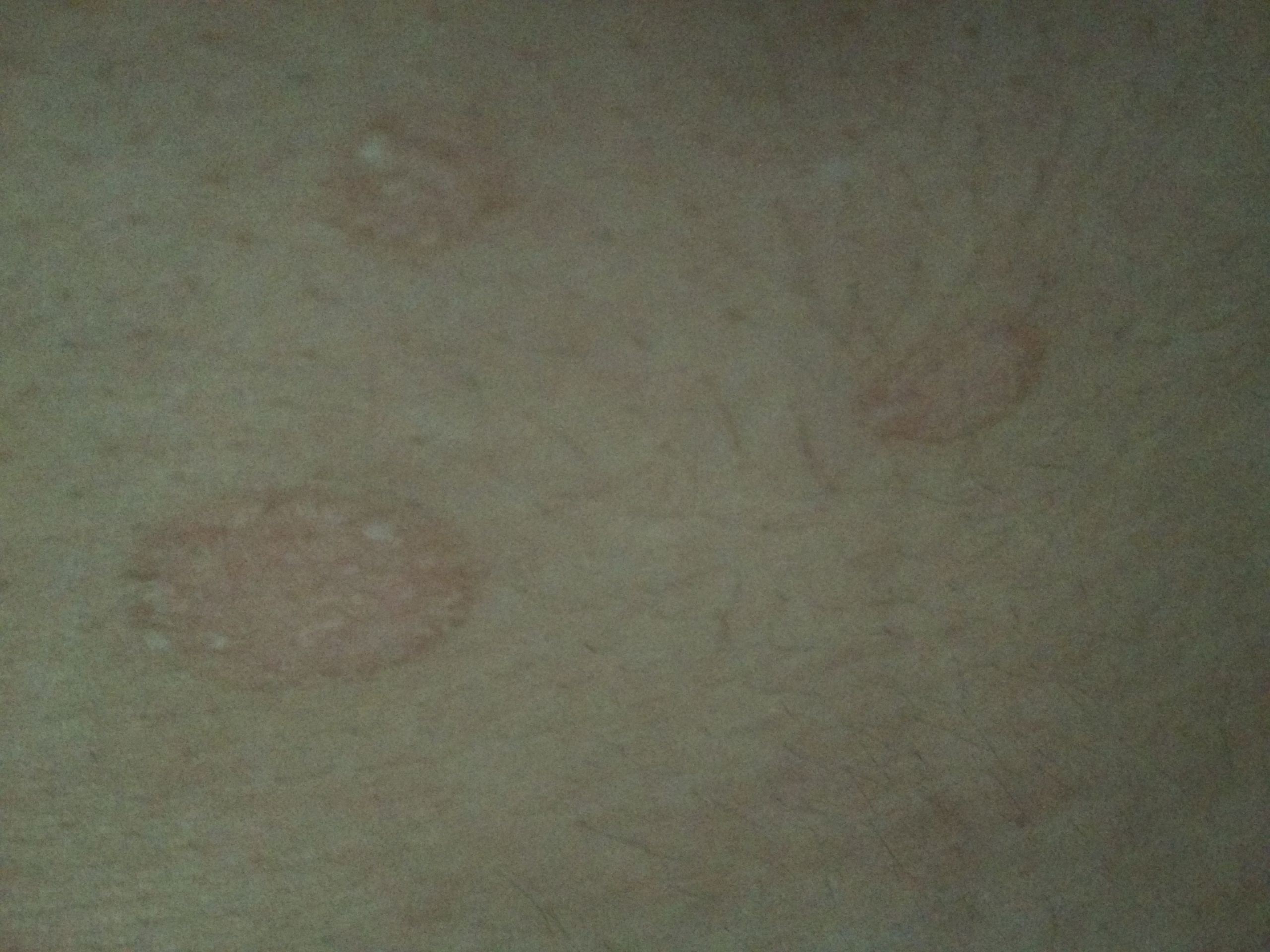 首页 皮肤性病科 皮肤科身上起了好多小红圈,越来越多,里面还会脱皮.