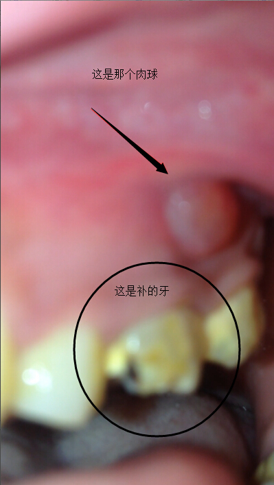 牙倒是不疼了,不过补的牙牙龈上面长了个肉球,吃辣的上火的东西会变大