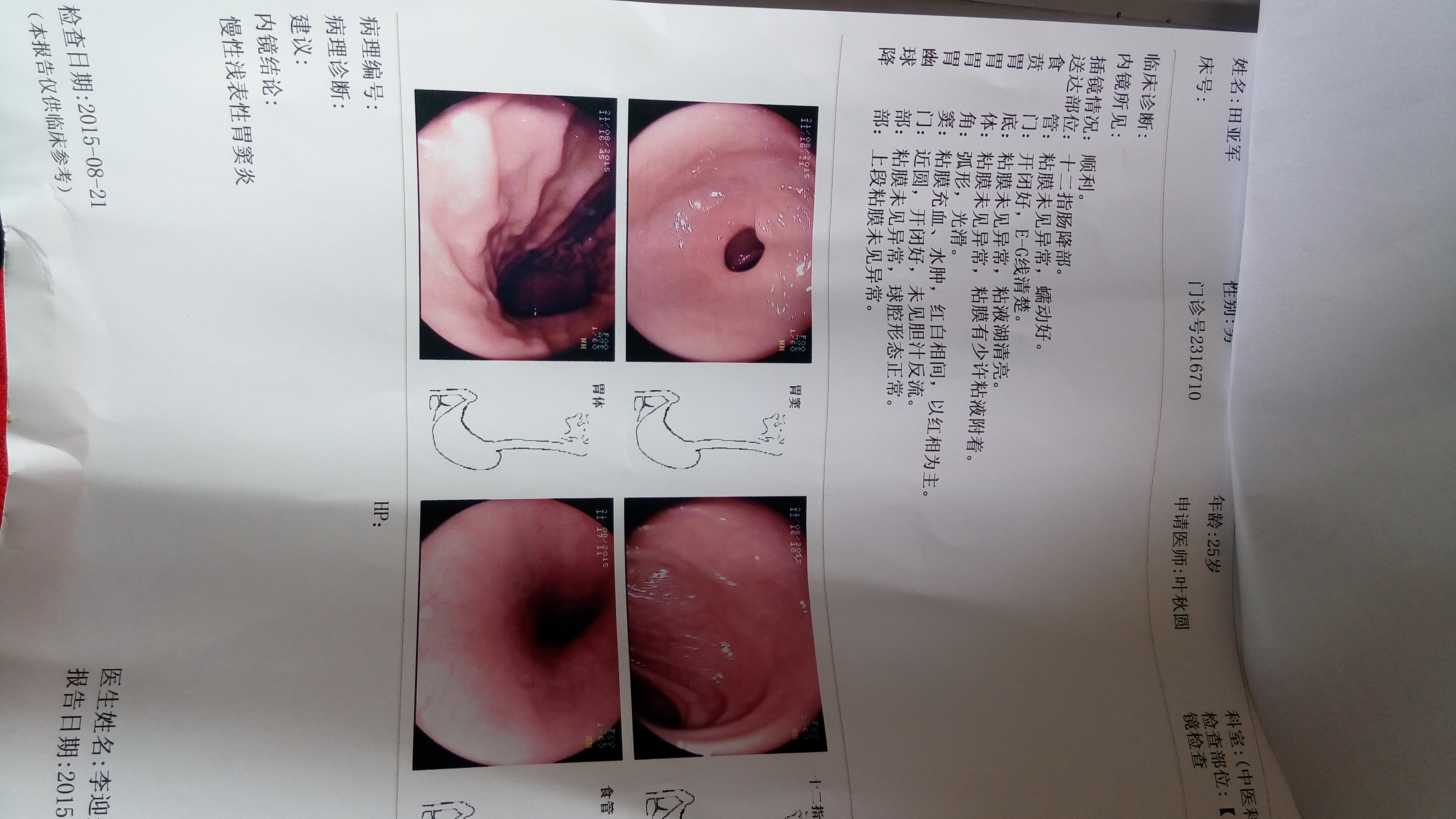 你好我胸悶疼偶爾打嗝總感覺喉部有東西堵塞到醫(yī)院做了胃鏡說是胃