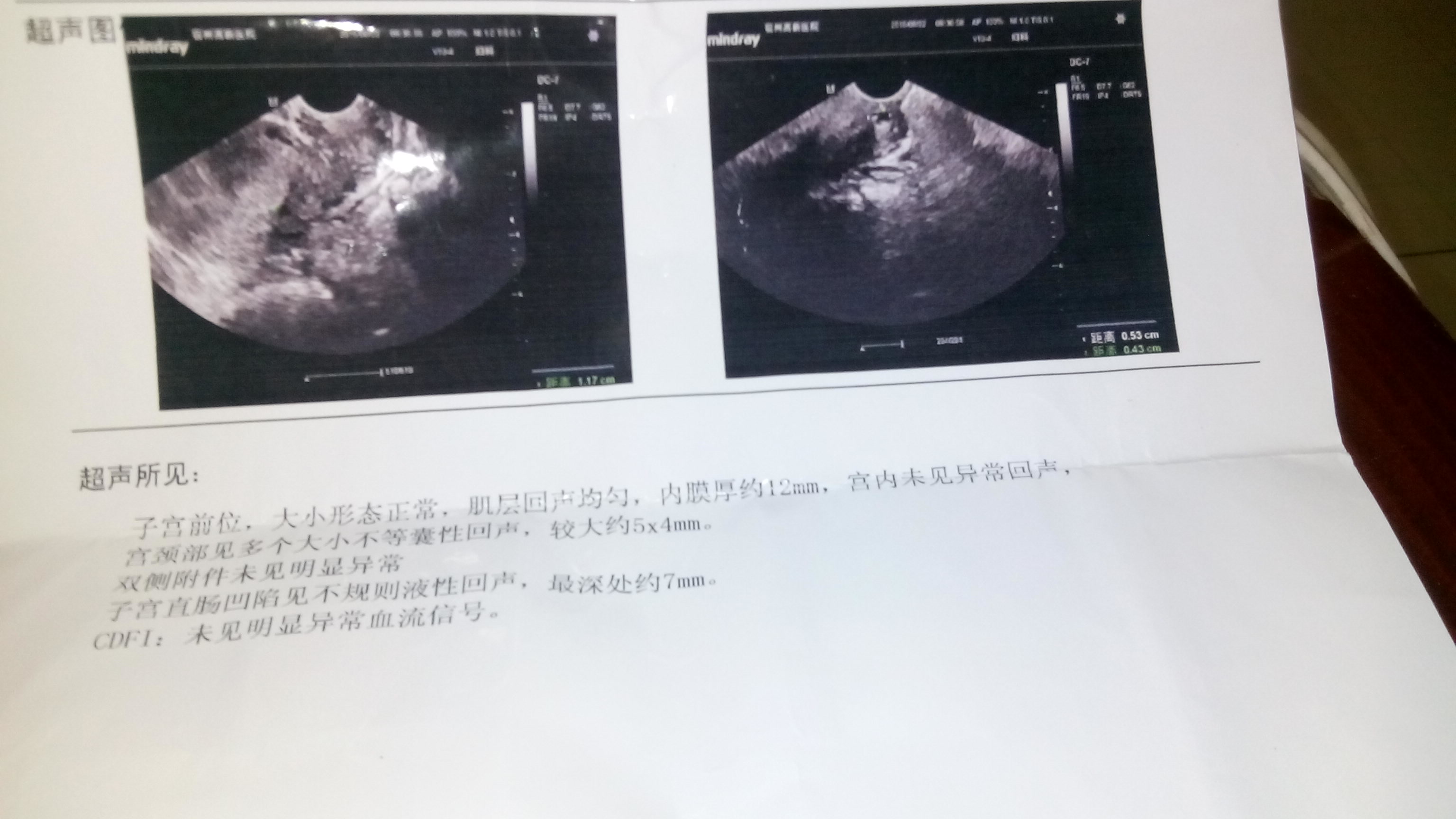 最近一兩個(gè)月，有過(guò)藥物流產(chǎn)，現(xiàn)在有霉菌性陰道炎，還有宮頸囊腫