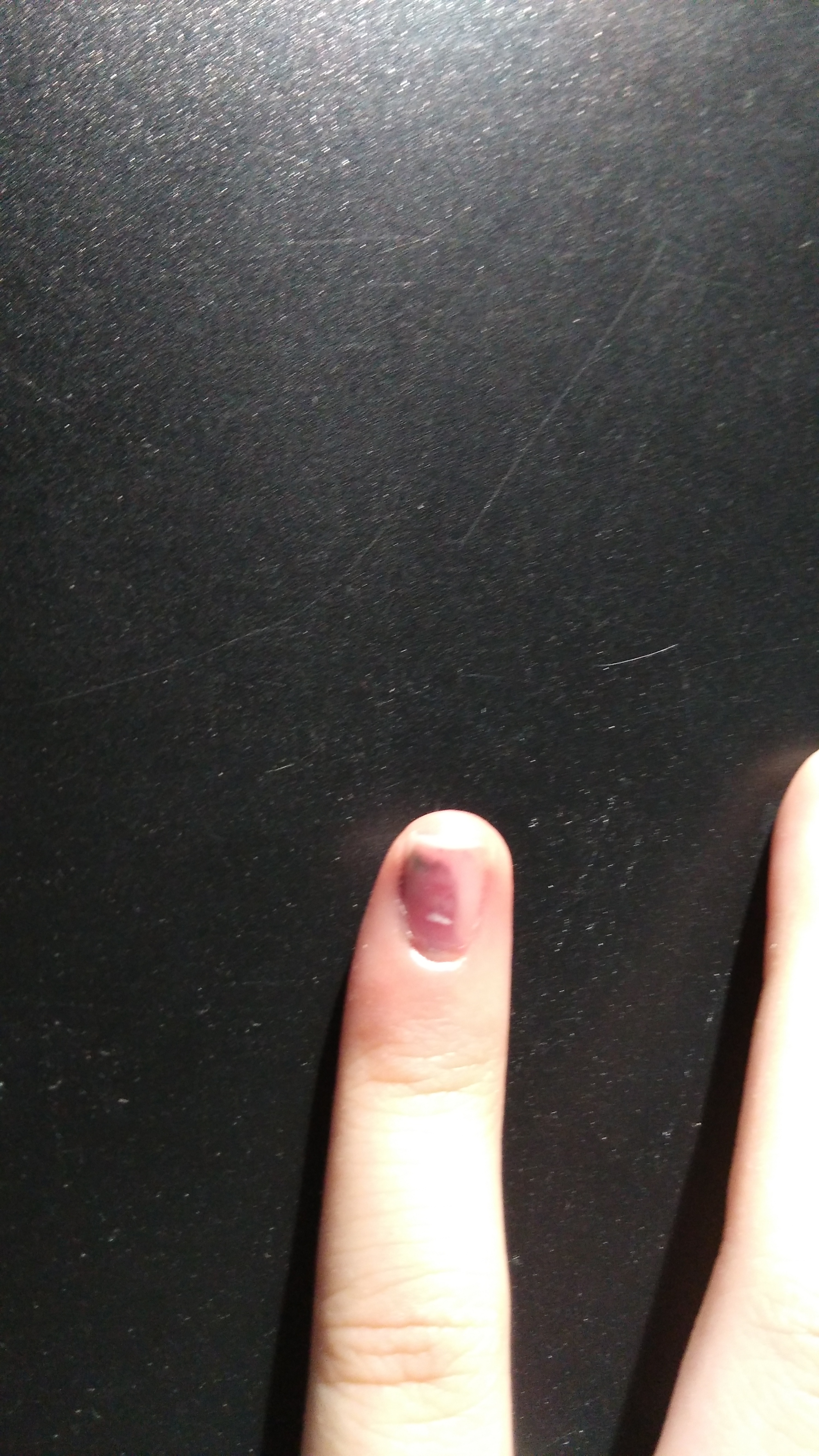 昨天晚上被车门挤了,淤血蔓延了小拇指指甲的一半,淤血最前端发