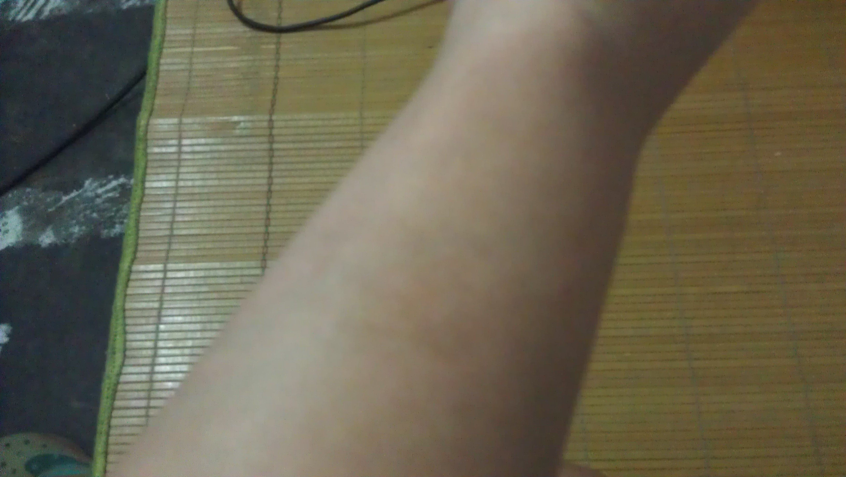 胳膊上腿上屁股边缘都是灰色的斑点,是怎么回事,有的人说是体内