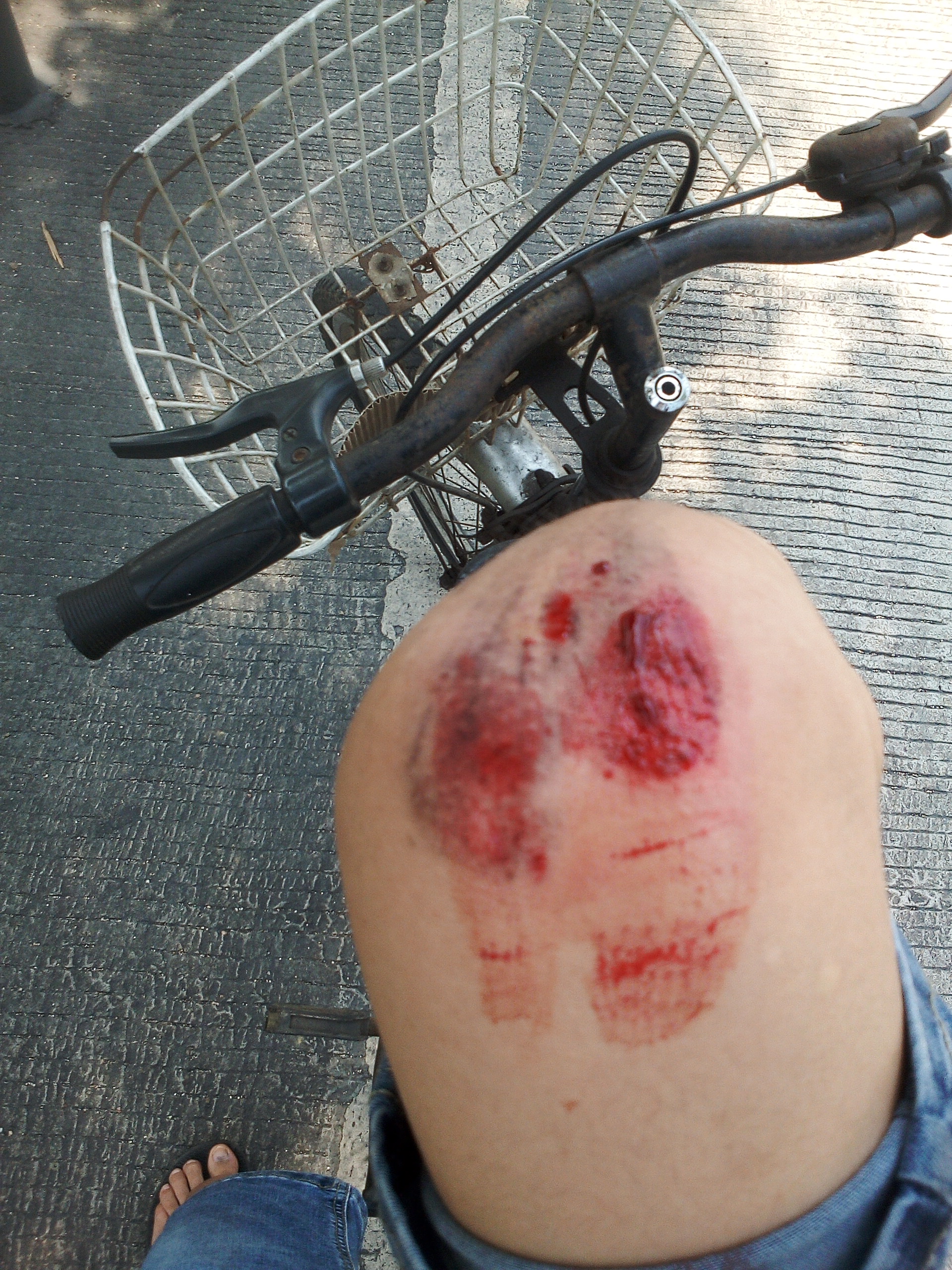 昨天上午骑自行车摔伤的手上也有伤,不能吃什么吗
