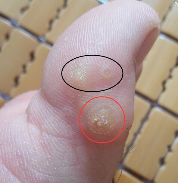 前两个月我的脚拇指侧边开始长一块像茧一样的死皮红色圈圈