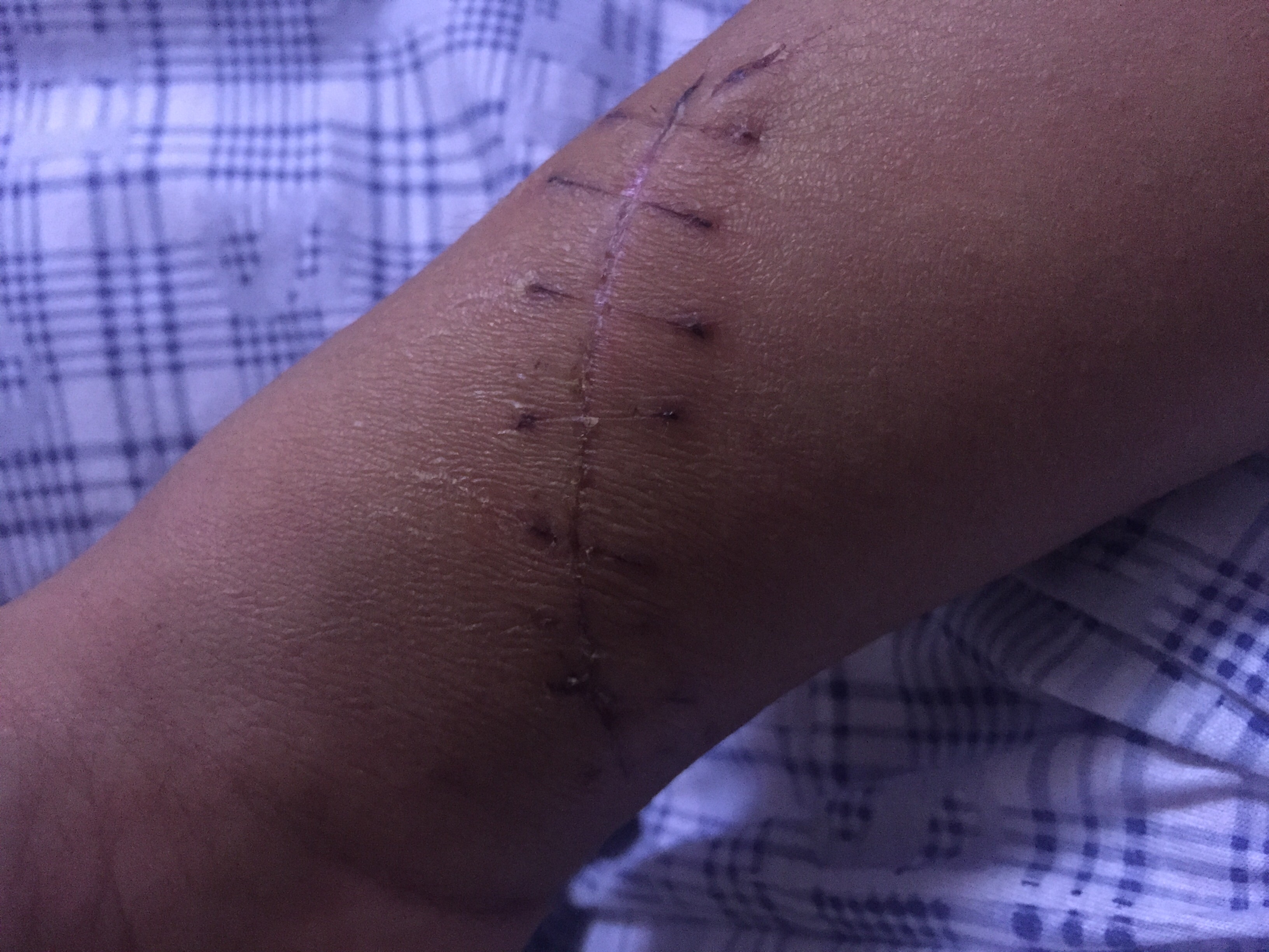 你好医生,15天前,我的手腕内侧被人砍了一刀,伤口9厘米,断