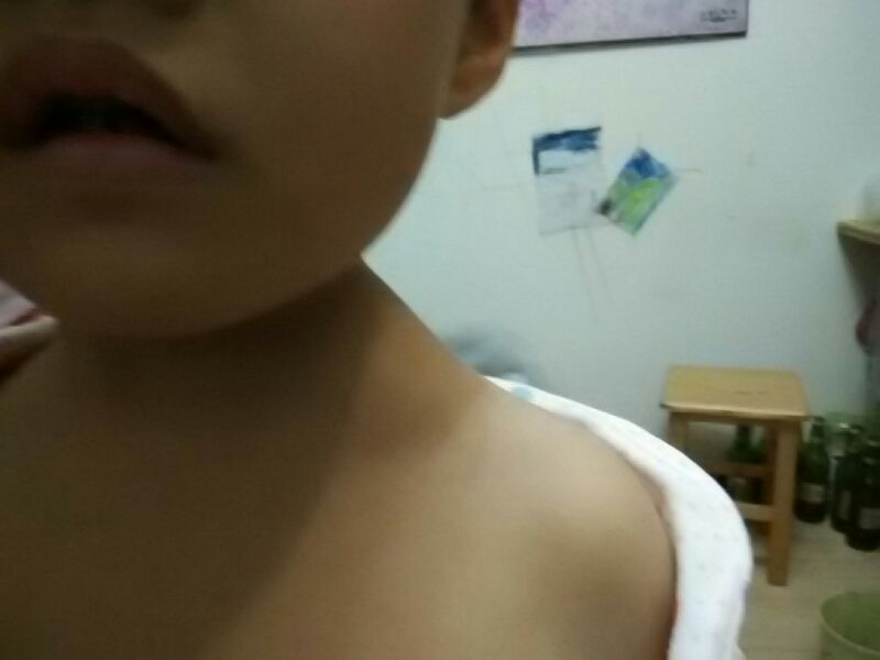 女孩6岁左肩膀长了个大包不疼颈部跟到肩膀部位彩超显