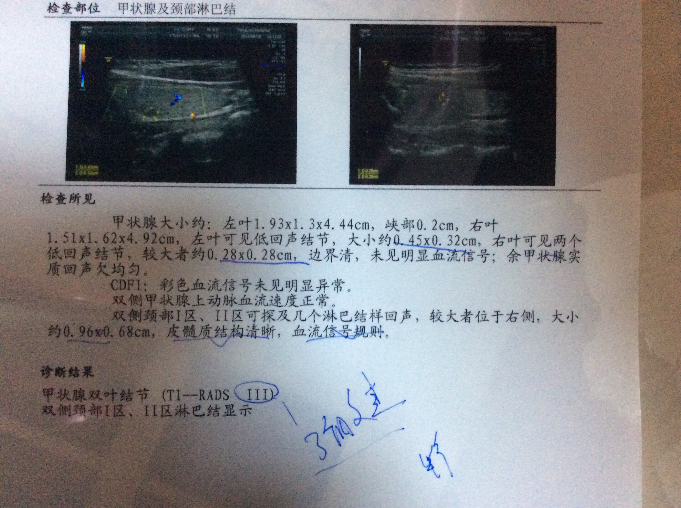 我8月30日做彩超检查甲状腺结节左侧有一个33毫米的边界