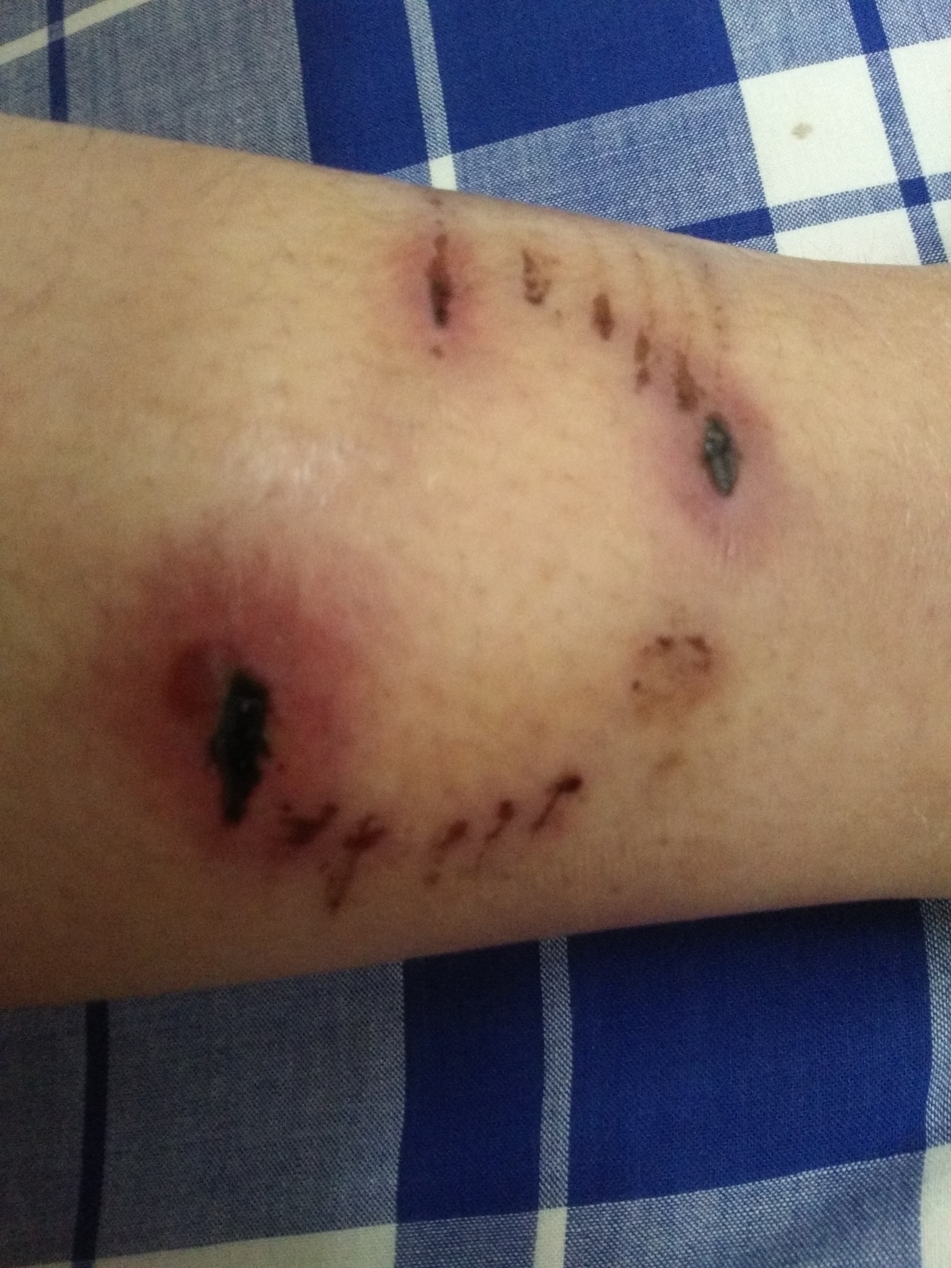 我被狗咬了十天了,咬的是右小腿,该打的针都打过了,伤口已经结