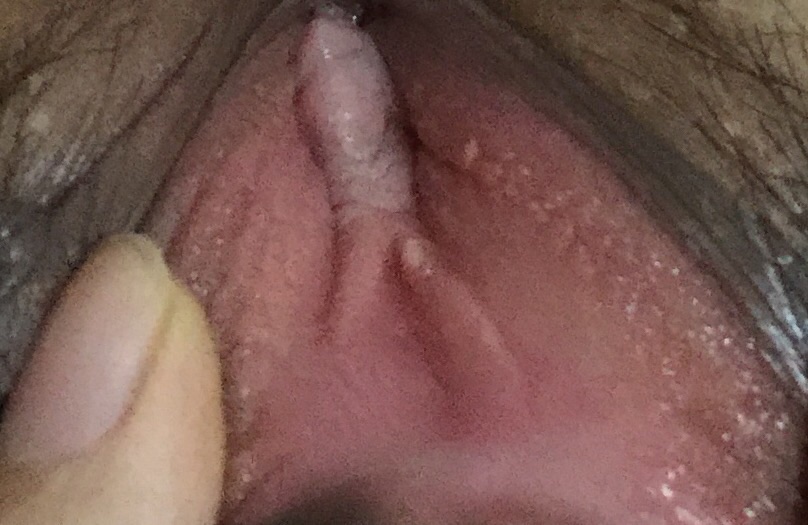 27。正在用治療陰道炎的藥剛好一周，上次查了有霉菌。昨天跟老
