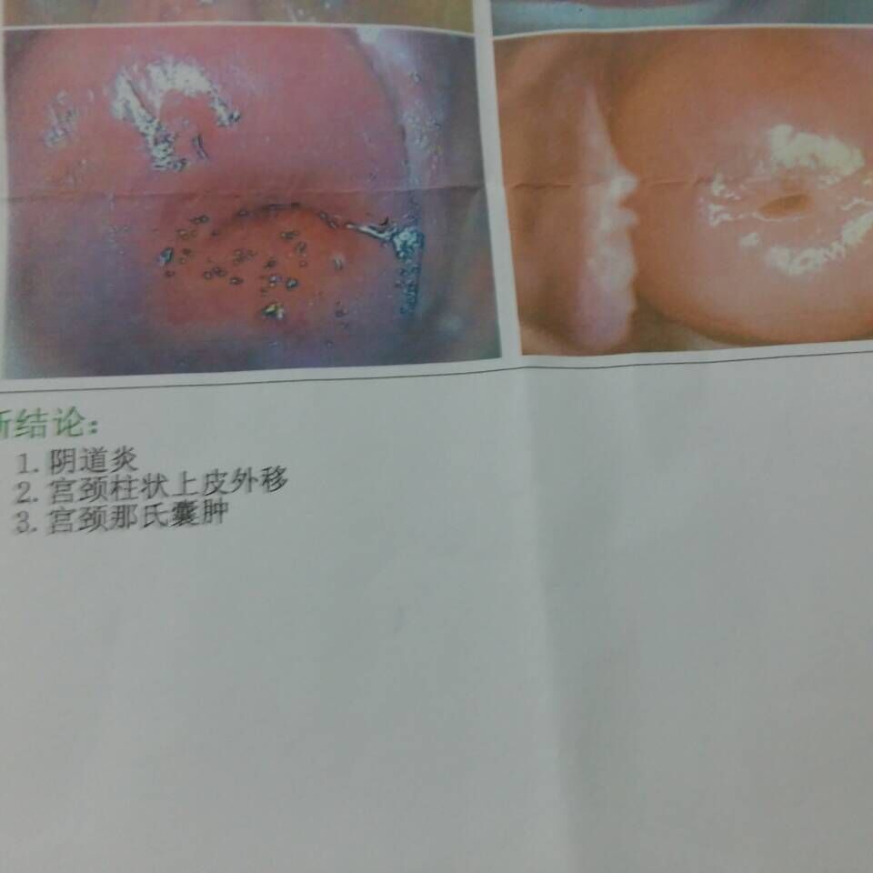 我20歲，去醫(yī)院檢查婦科，得出結(jié)論陰道炎，宮頸柱狀上皮外移，