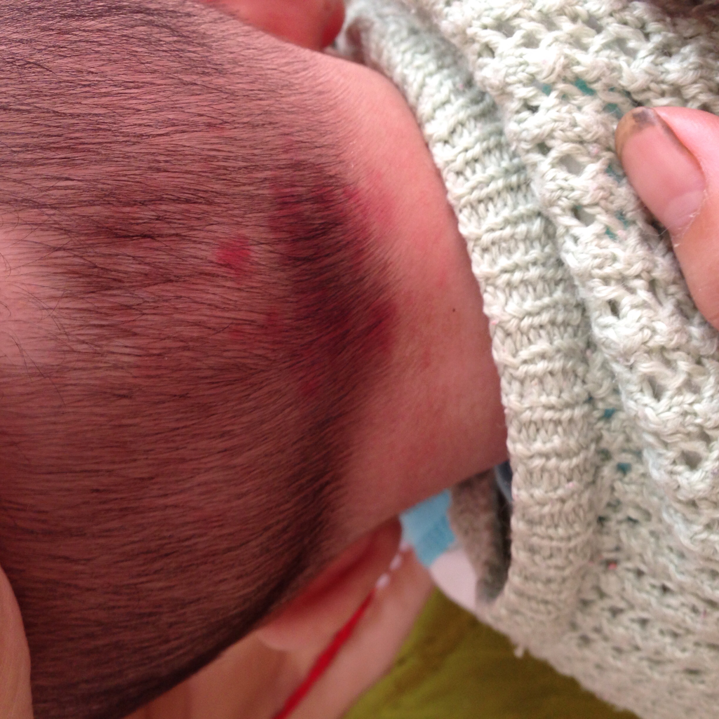 婴儿脸上红斑，出生到现在已经7个月大了，该处红斑从出生到现在一直未消退（欢迎不倒翁52 继续回 - 百度宝宝知道