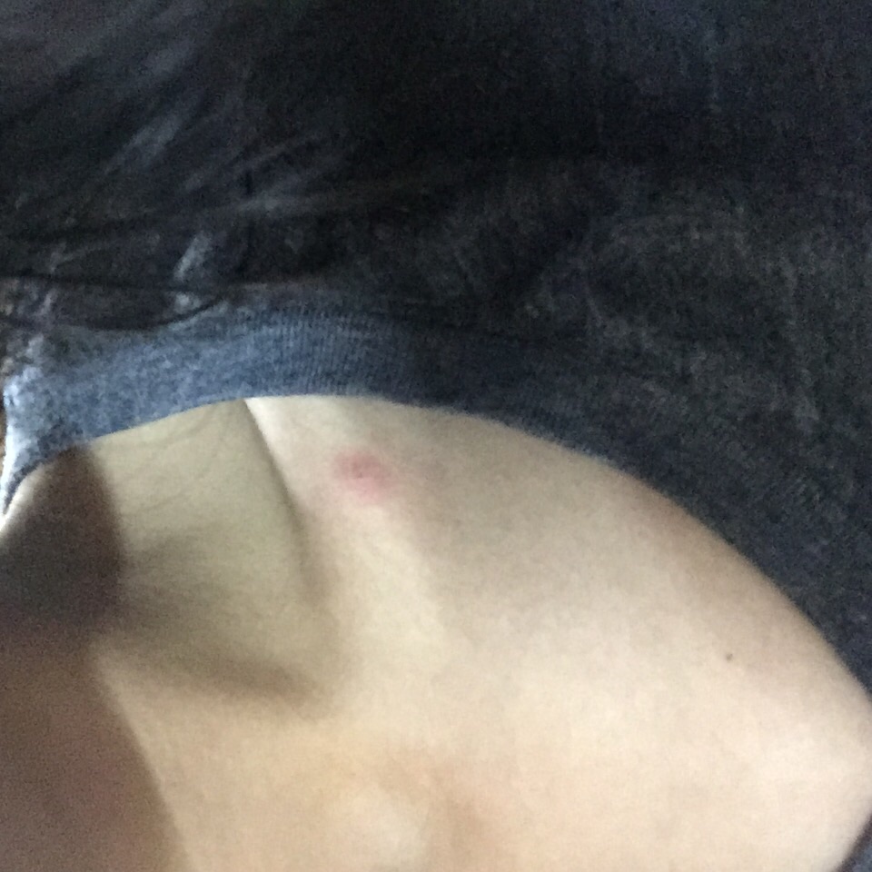 早上起来突然脸上长了好几粒痘痘,身上腿啊肩膀啊也有几粒脂肪粒