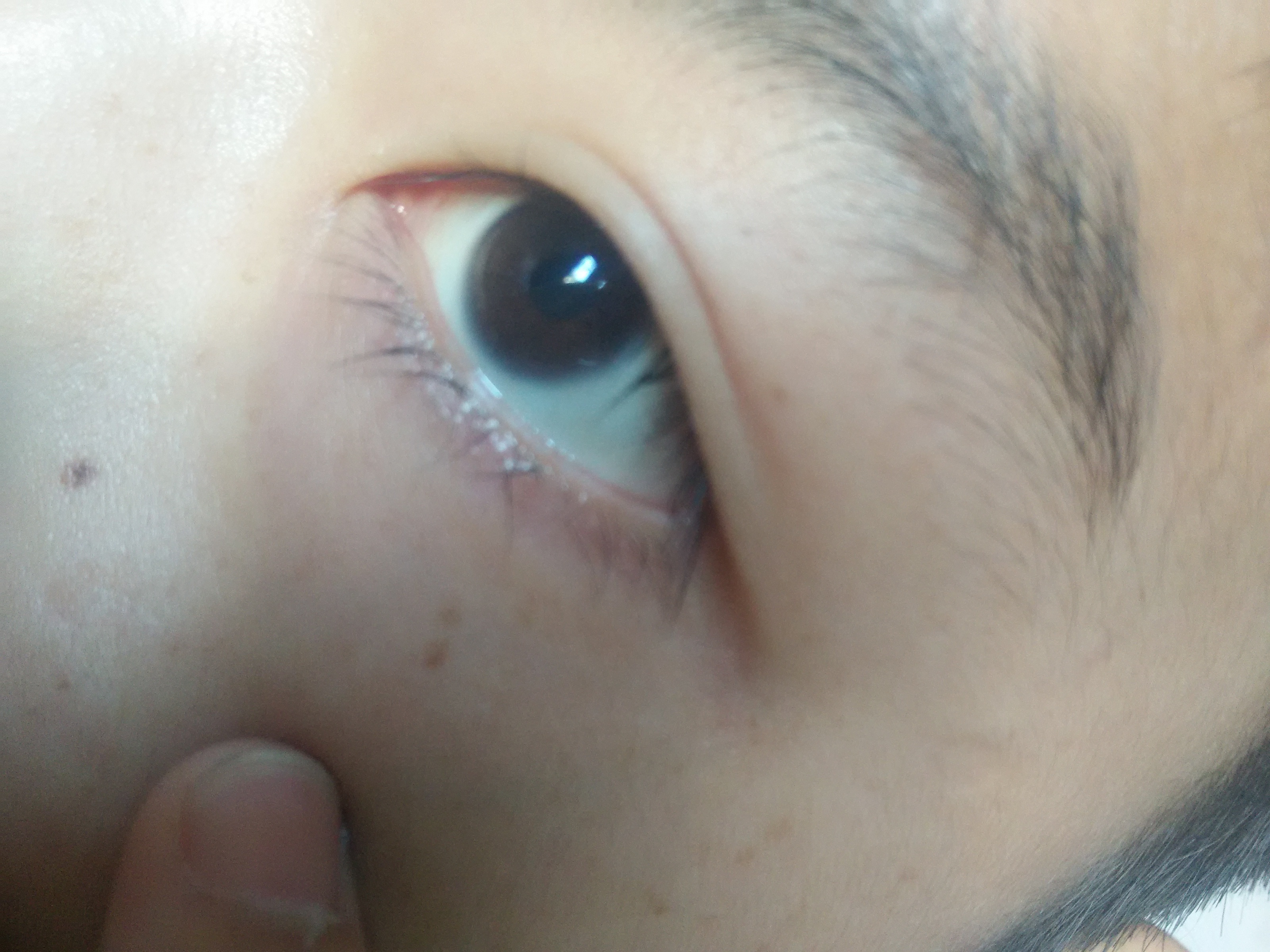 眼睑炎？下眼皮里面长了透明小泡 大概长了一两个月了。没有消退。不痛不痒，什么感觉也没有？ - 知乎