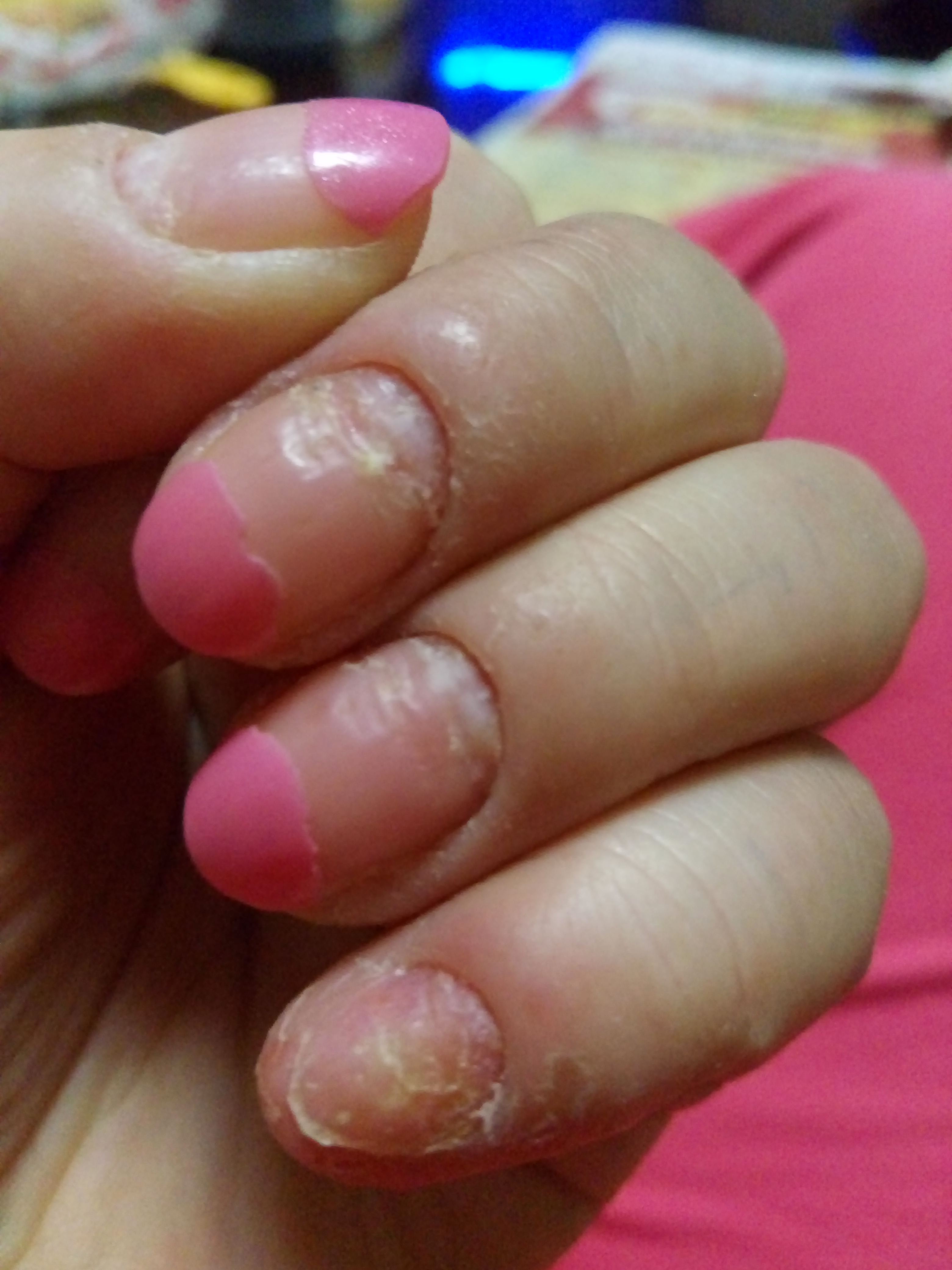 手指甲根部开始凹凸不平,刚开始有手藓在治疗中,最近两星期手指