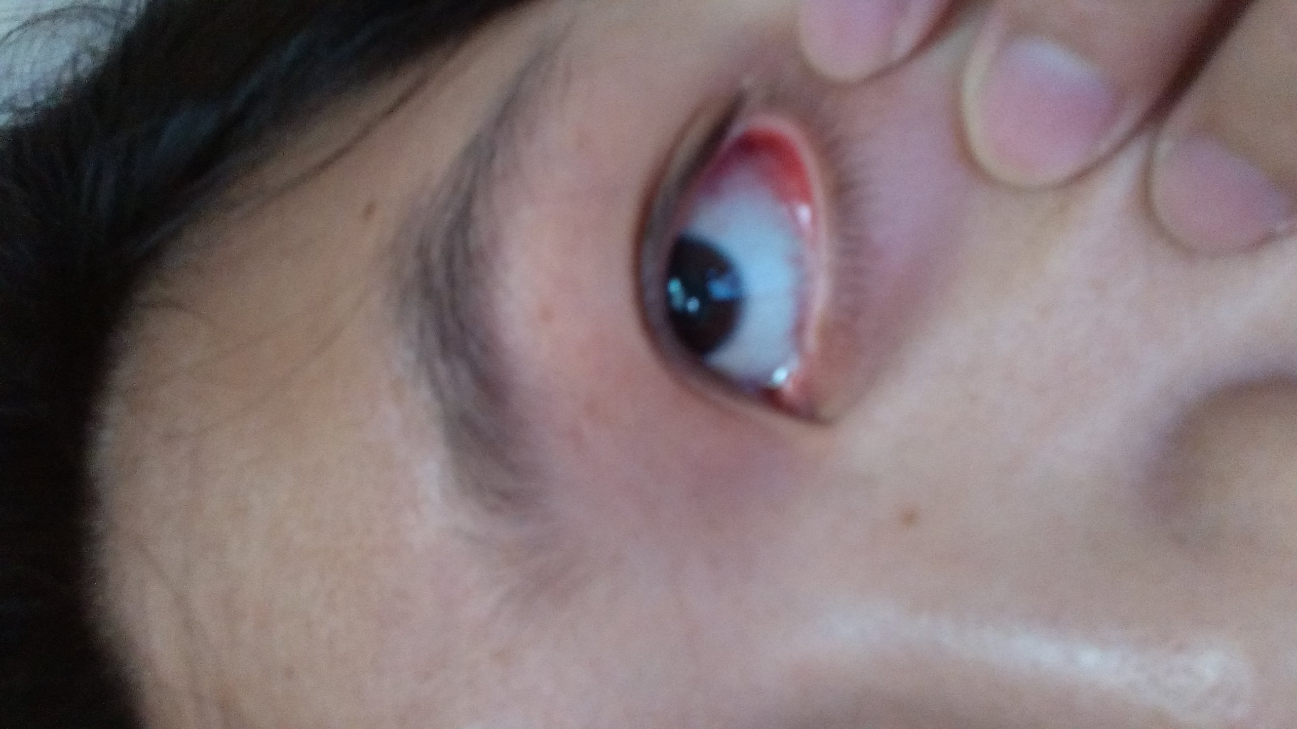 医生我外眼角痛了三天了,外眼角里面红肿的,眼角皮肤长了个小包