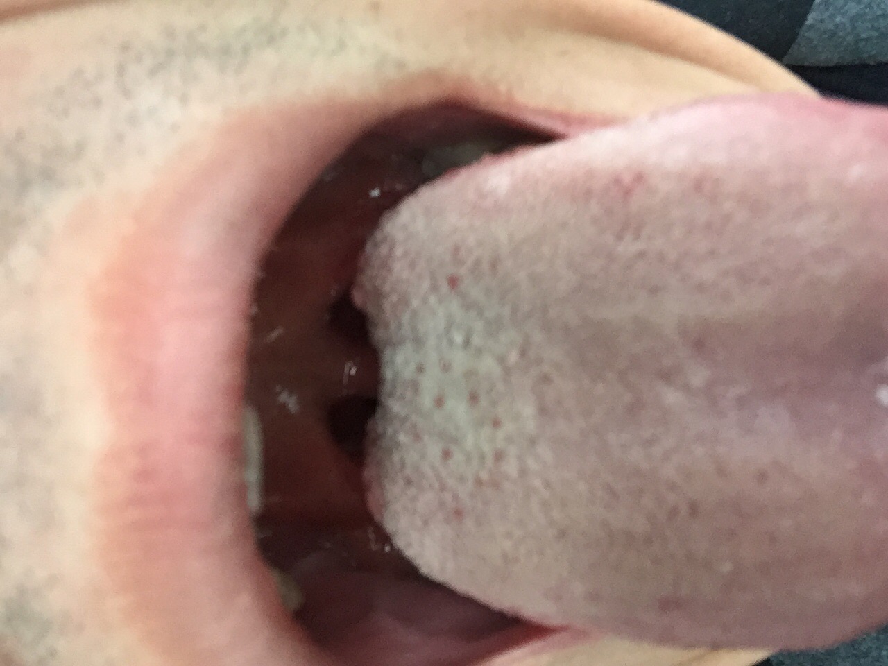 前几天发现舌头上长了红点,舌头根部红点比较大有一点点凸起来