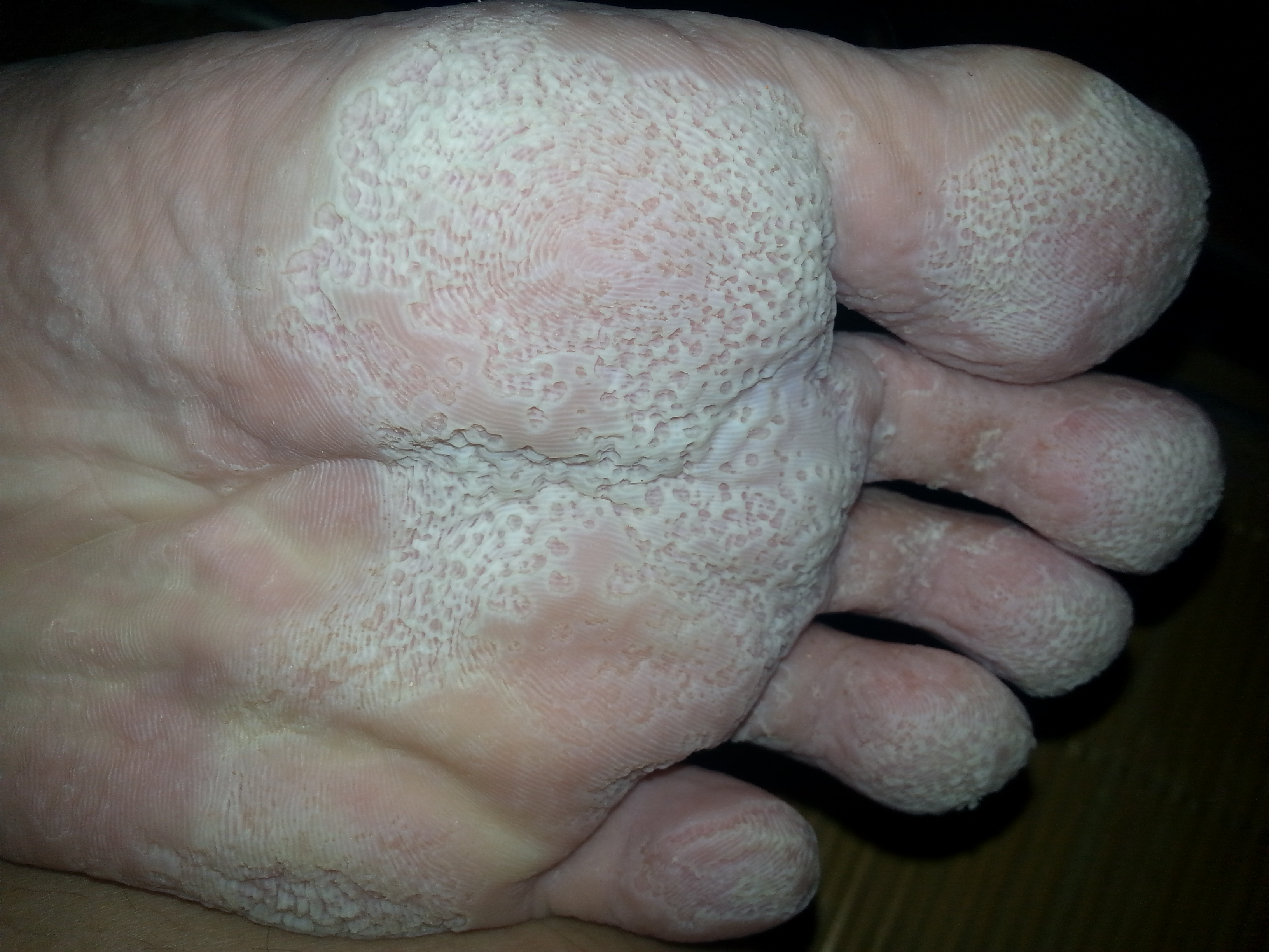 双脚脚底由于穿了劣质皮鞋导致脚底皮肤烂了经常出汗而且有严重