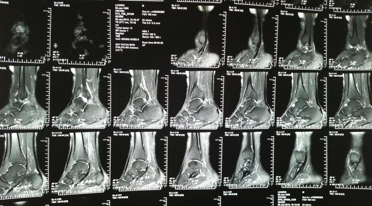 儿童踝关节骨化中心,踝关节骨化,儿童踝关节骨骺(第2页)_大山谷图库