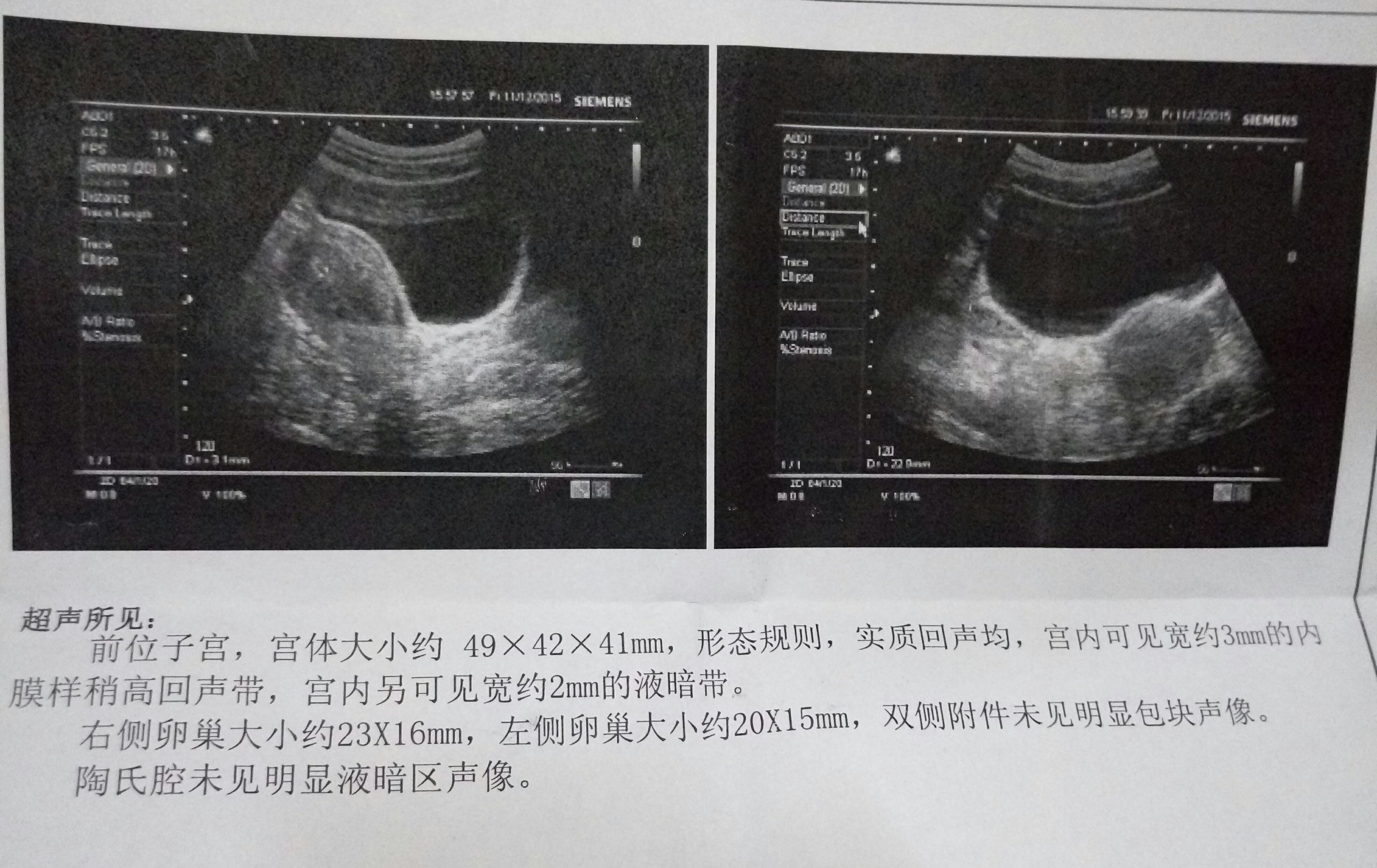 12.2號做的人流，今天去復(fù)查，醫(yī)生說沒干凈，給我開了藥，讓