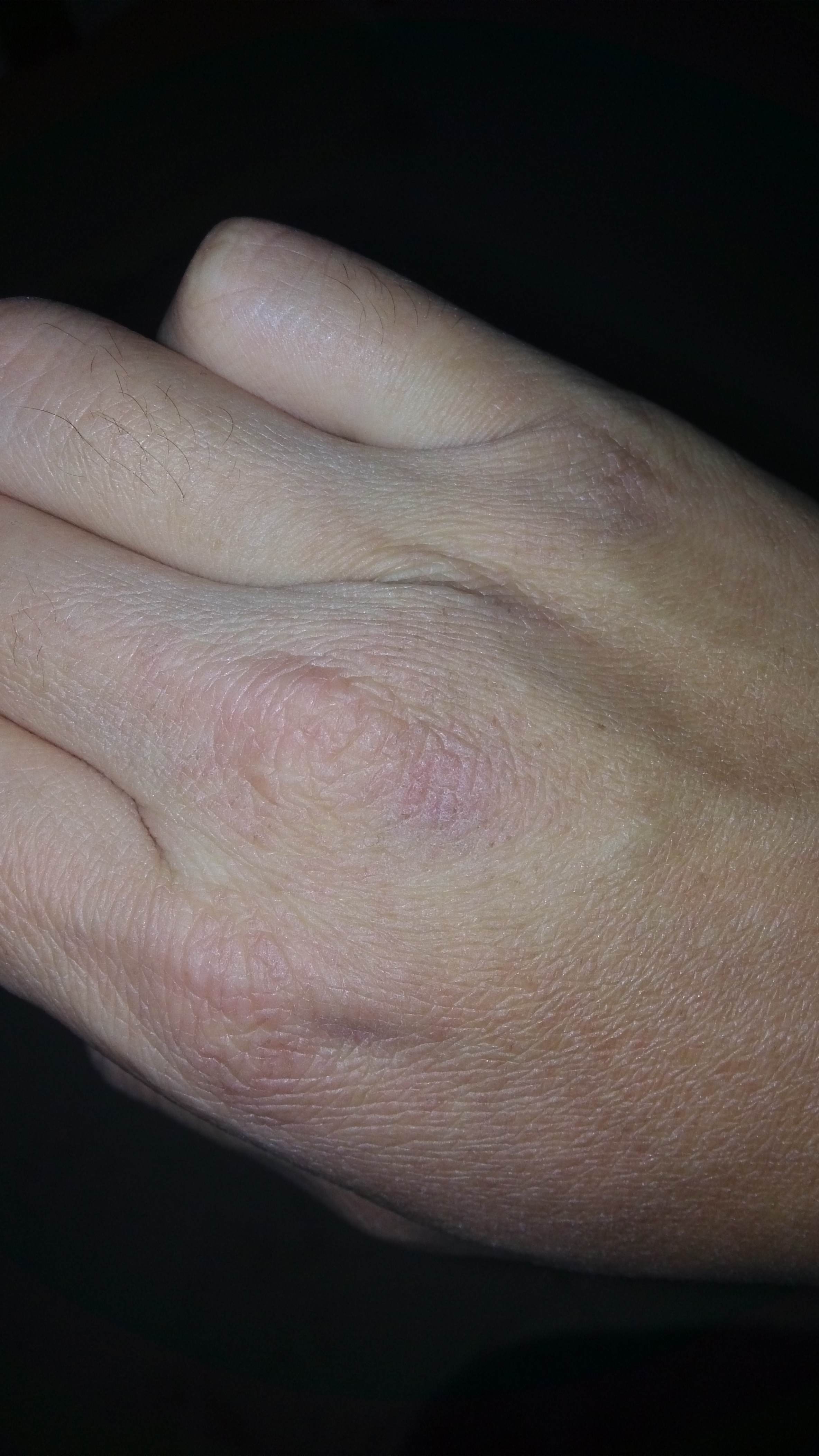 请医生看下我手背的干裂和红点，这是被冻的还是一种皮疹