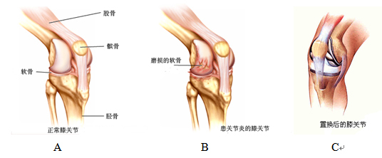 什么是人工膝关节置换术呢?