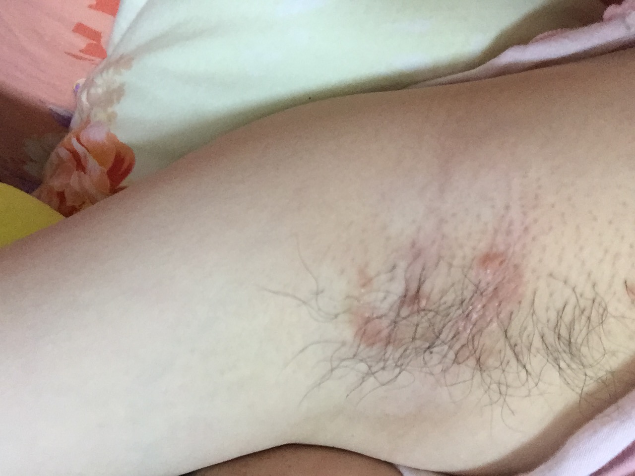 一侧腋下出现红斑,很痒,是不是真菌感染,应用什么药