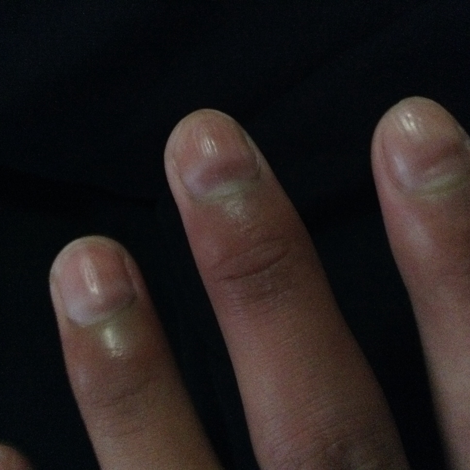 手指甲根部发紫且凹陷,这种情况将近有1个月了.问过医生,医生