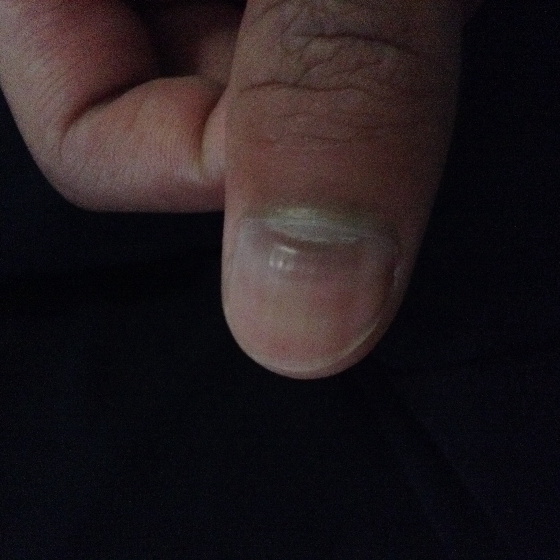 手指甲根部发紫且凹陷,这种情况将近有1个月了.问过医生,医生