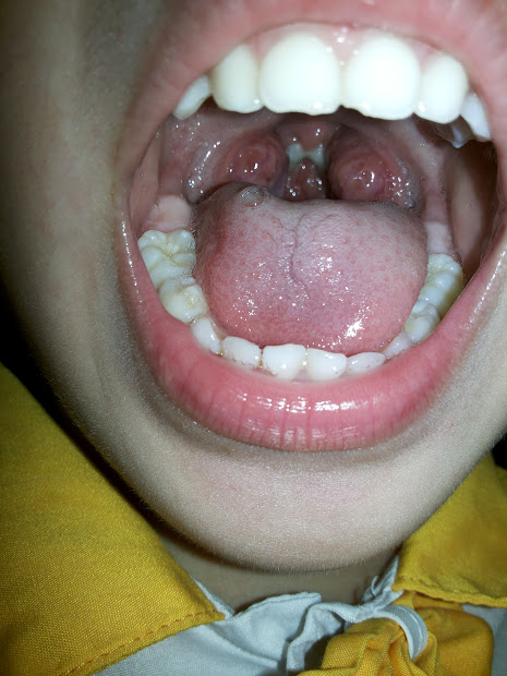 请问我孩子喉咙怎么了喉咙俩边红红肿肿的照片俩边有俩块红