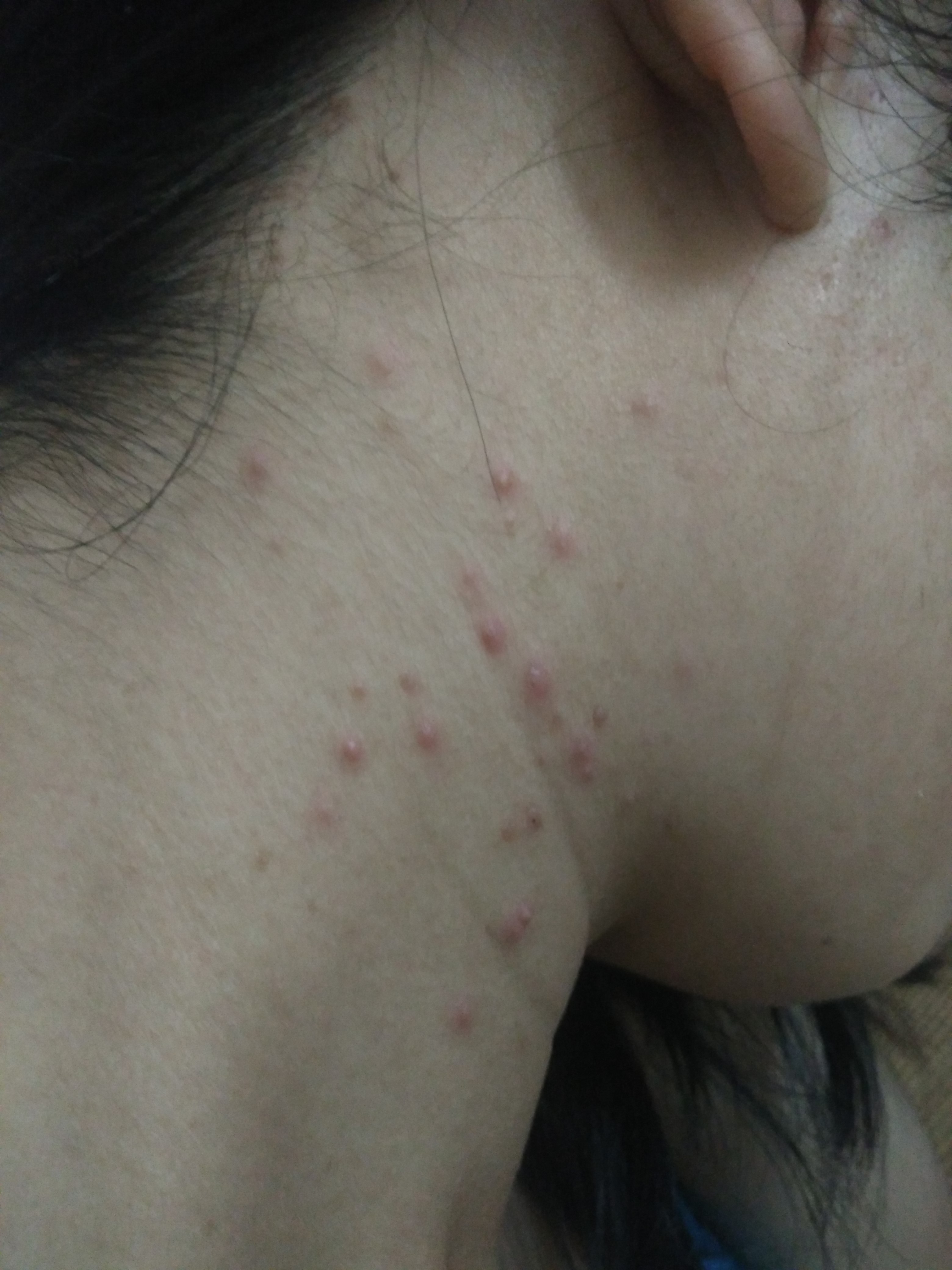 我的头上已经痒了一年多了,但这个月脖子背上才起了很多痘痘,又
