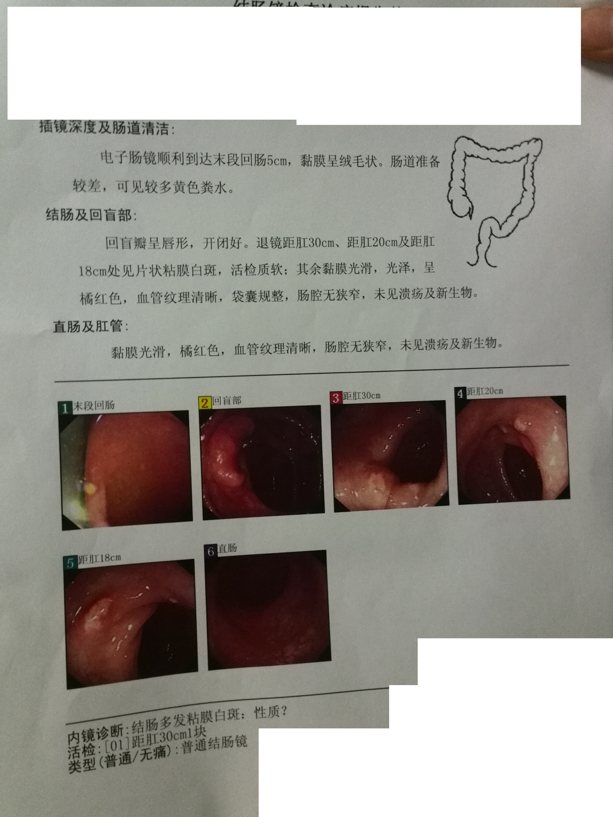 半年前左下腹部幾個(gè)點(diǎn)疼，去醫(yī)院做的檢查。