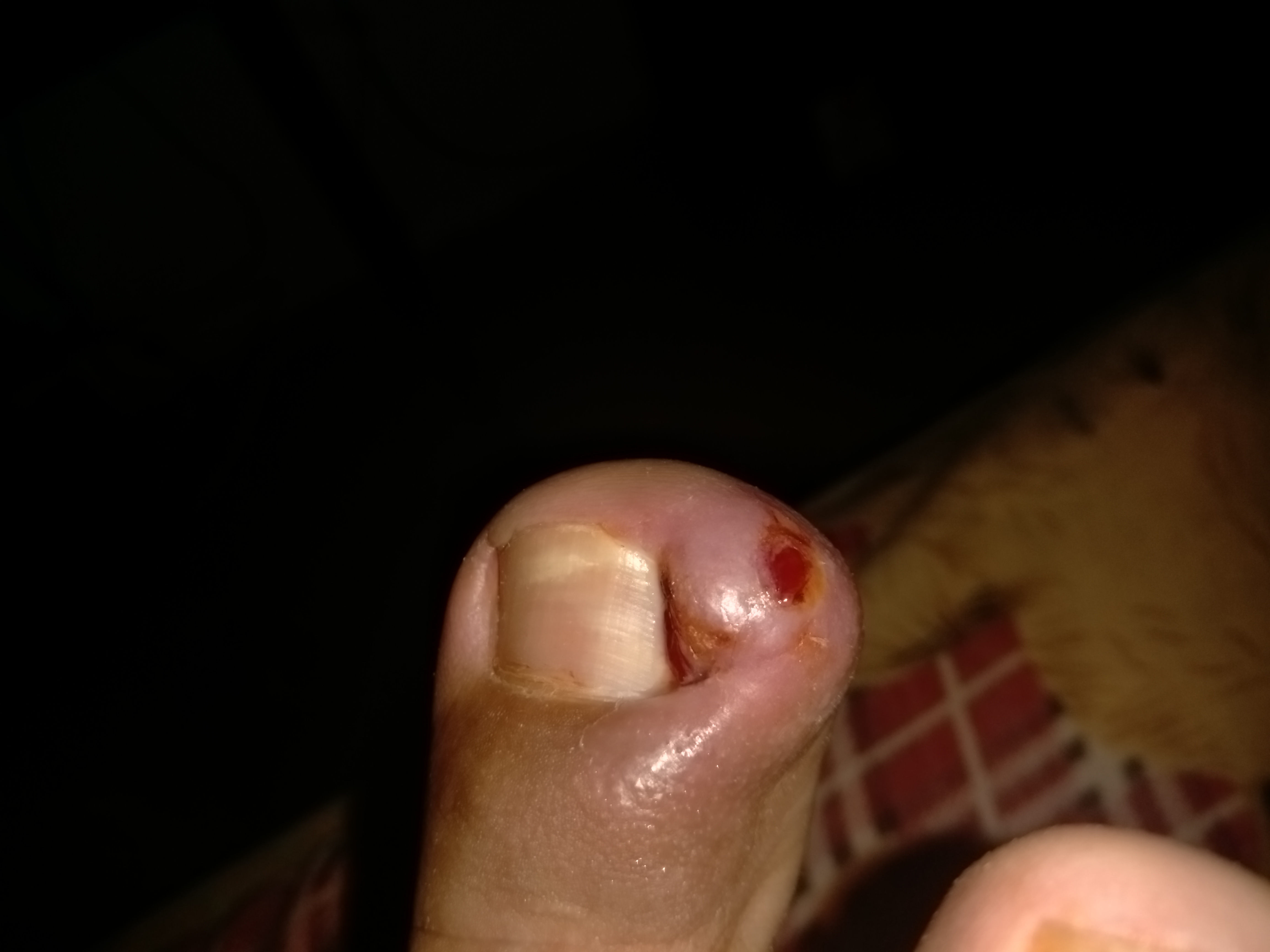 我右脚大拇指指甲太往里面长戳着拇指里面的肉导致右脚拇指血