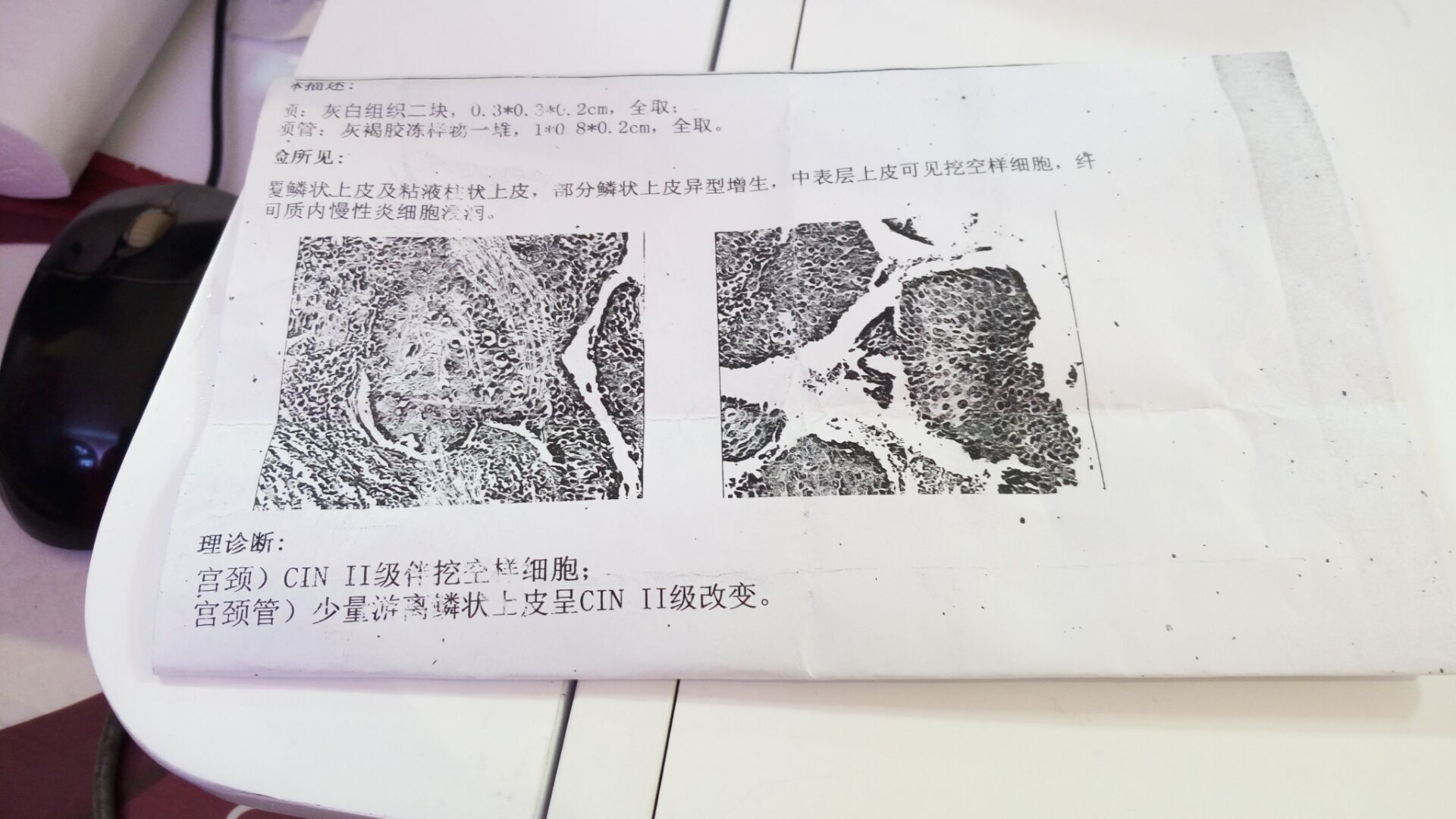 宮頸）CIN2級伴挖空樣細胞；宮頸管）少量游離鱗狀上皮呈CI