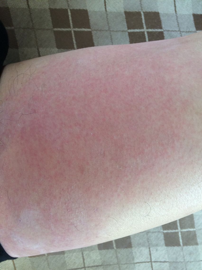 皮肤红痒,范围在扩大,有三天了,是过敏还是其他症状