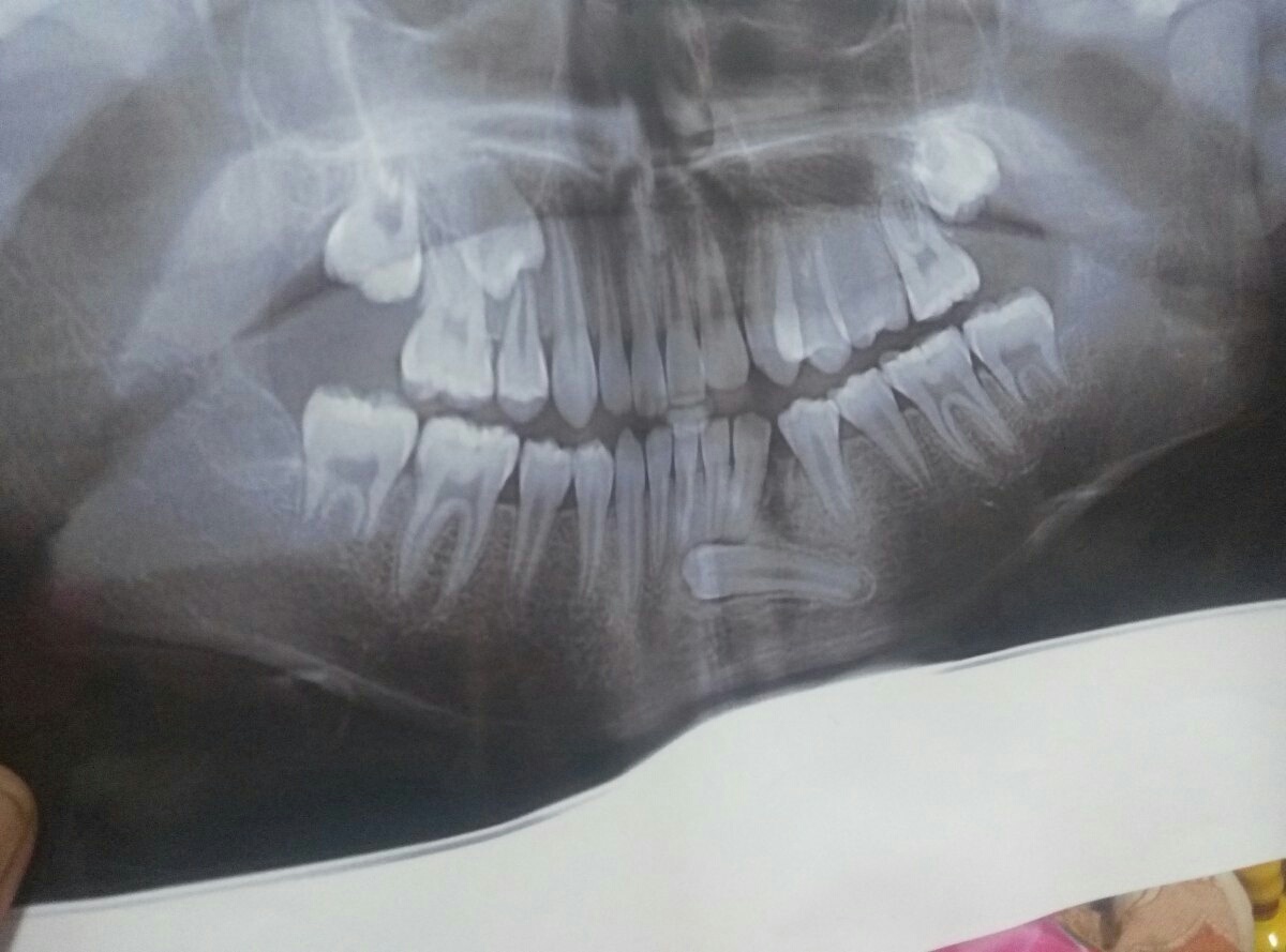 就是下排牙齿的牙根下方 曾经的治疗情况: 医院说需要手术 想得到什么
