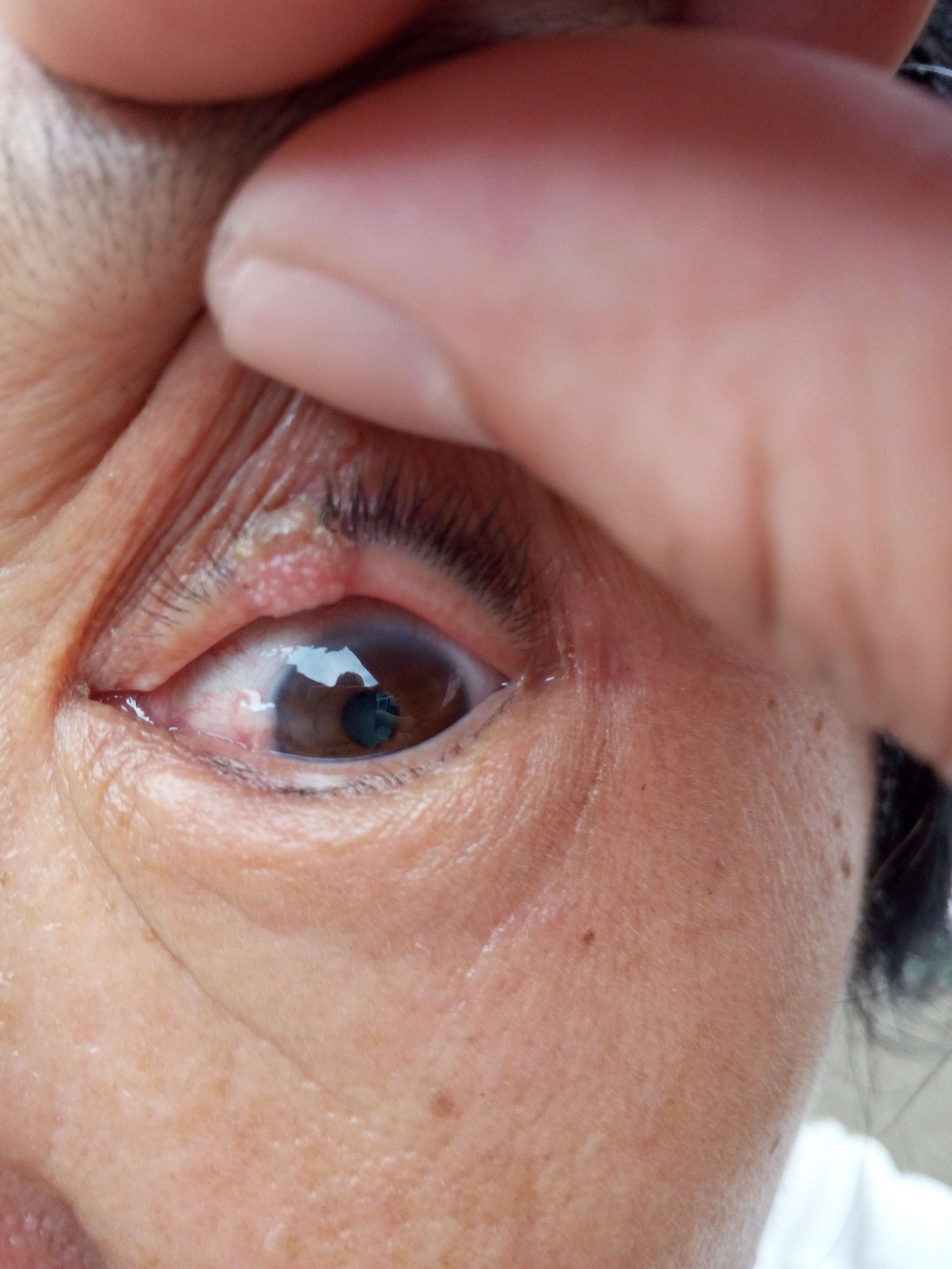 视网膜脱落可以治愈吗(具体有哪些症状？并发症有哪些？) | 说明书网