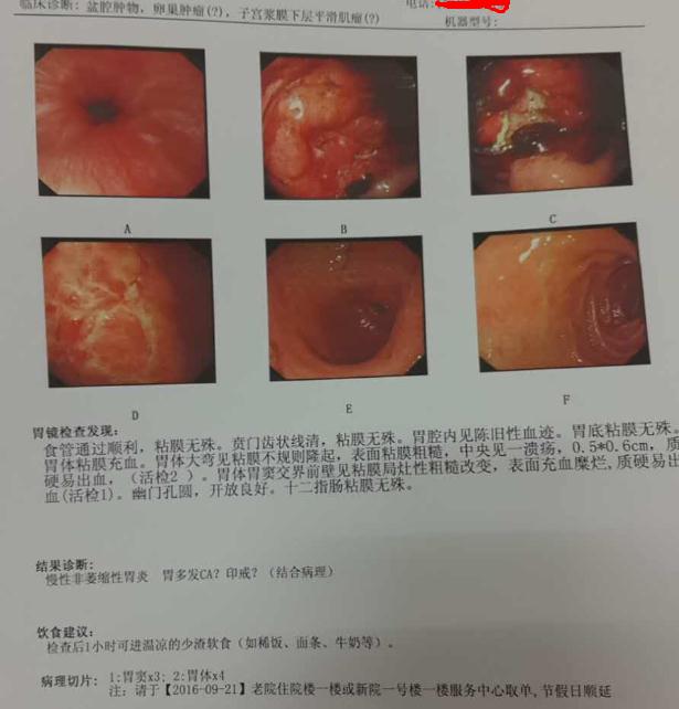 胃竇胃體低分化腺癌部分印戒細(xì)胞癌。剛剛開始以為是婦科腫瘤，在