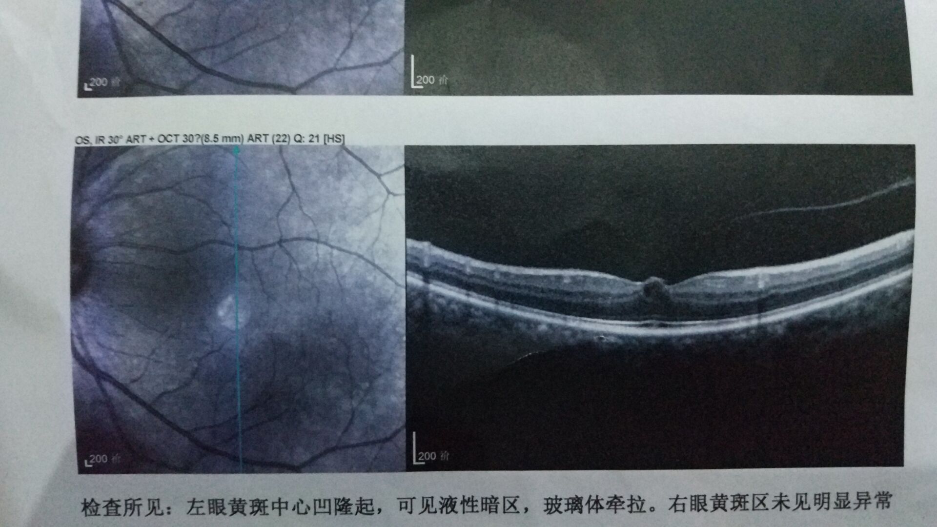 前一個月左右視力下降看不清去醫(yī)院檢查了，醫(yī)院說不能治療要去大