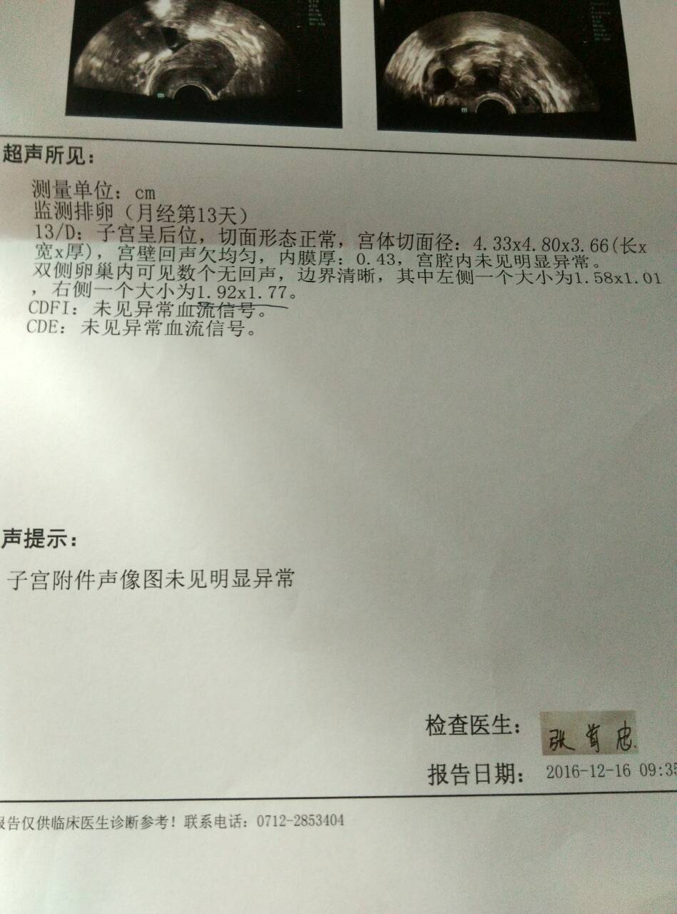 這是第二個月促排，4號來的月經(jīng)，今天是月經(jīng)第13天，右側(cè)卵泡