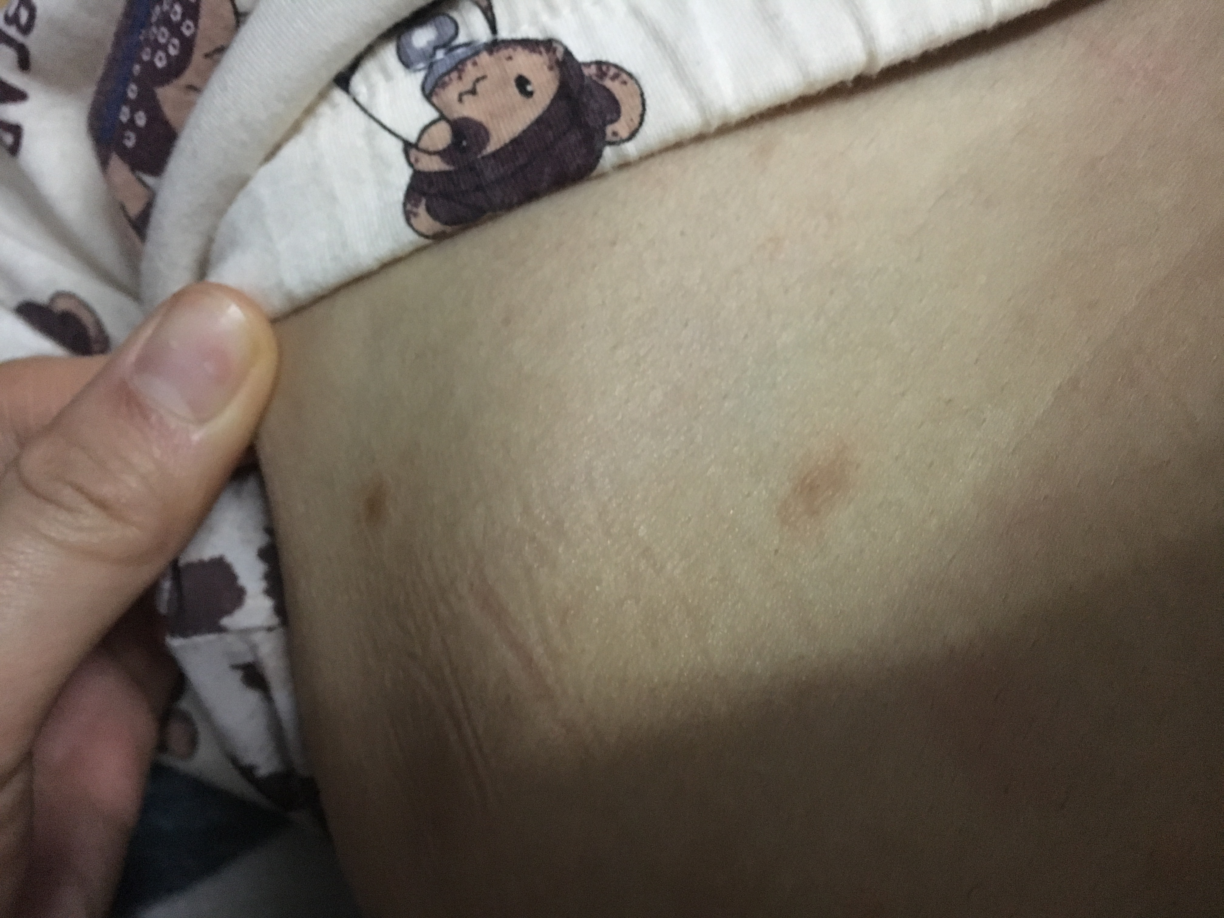 一开始腿上长一个,后来发现肚子和腋下腿上都有,摸起来凸出来的