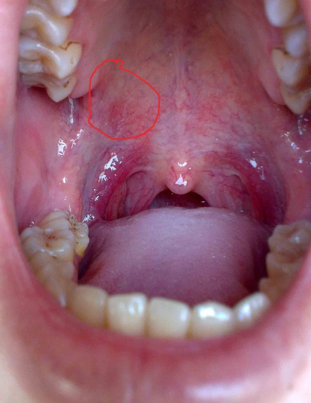 口腔上颚长个硬疙瘩,大概一个月左右,之前是上颚干疼