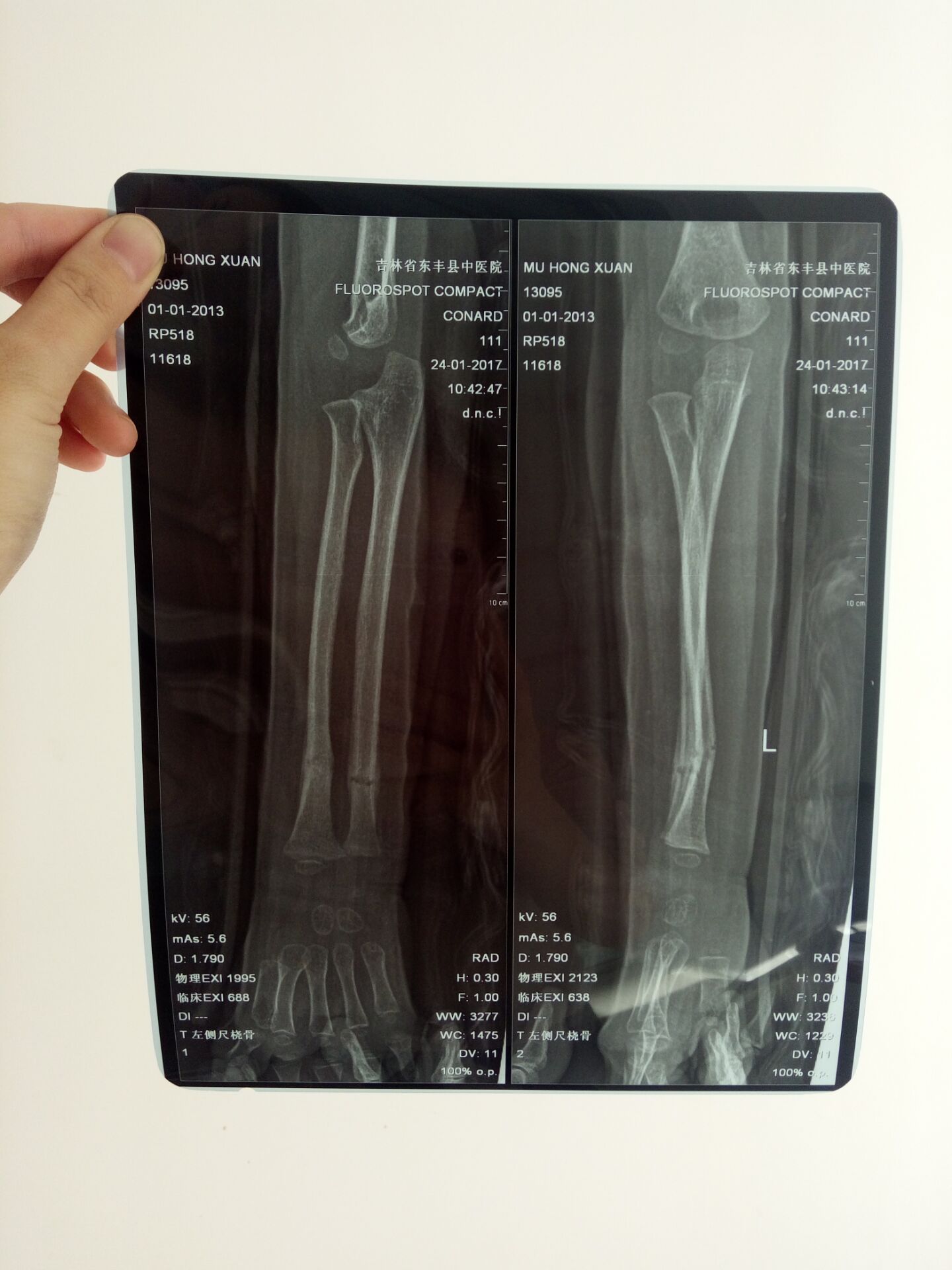 左胳膊骨折带的夹板已经一个月了一周前拍片子报告上说肘部关节结合